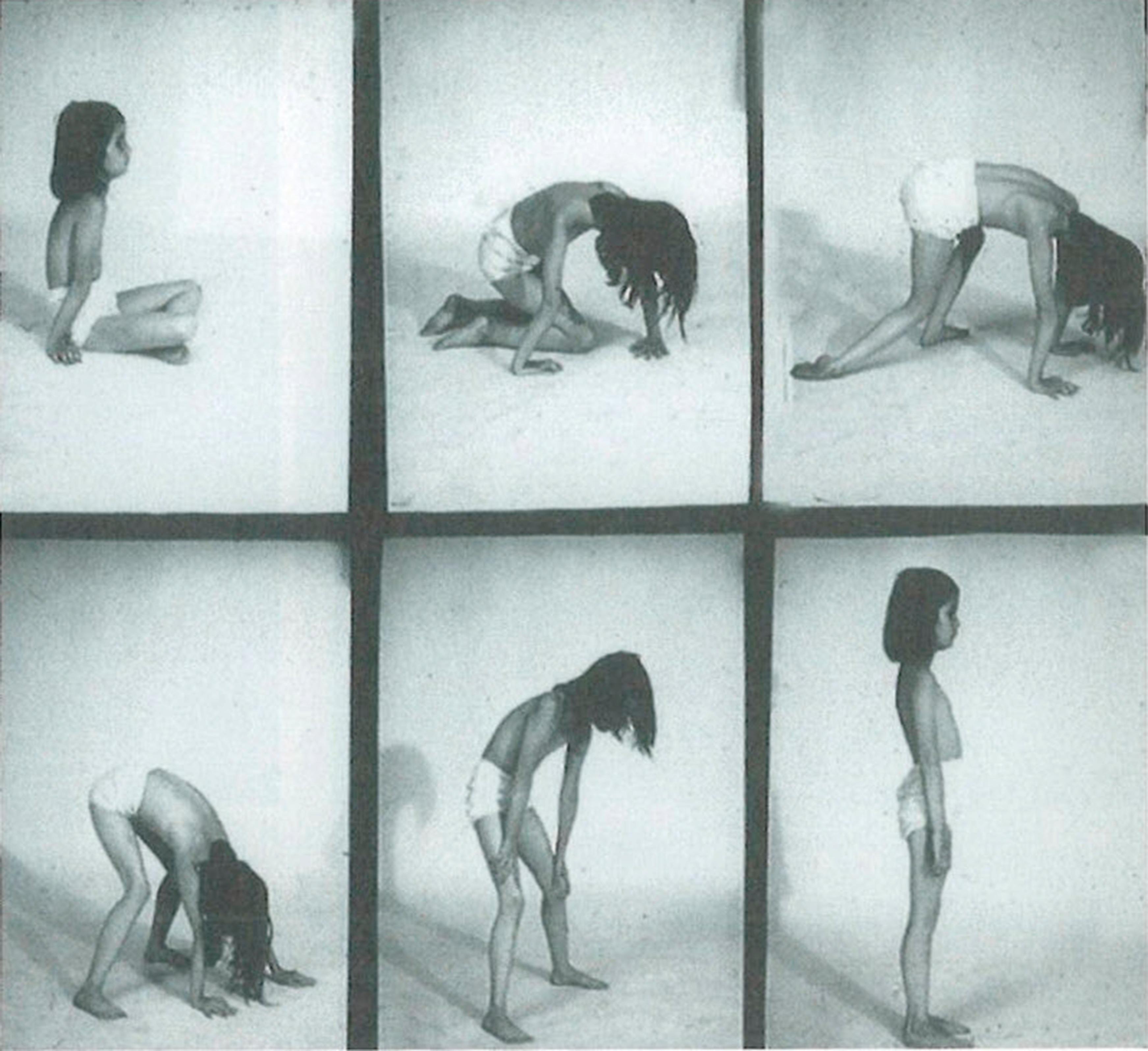 Fig. 1.4, Patient with juvenile acid maltase deficiency showing the Gower sign. Also notice the hyperextension of the elbow while sitting.