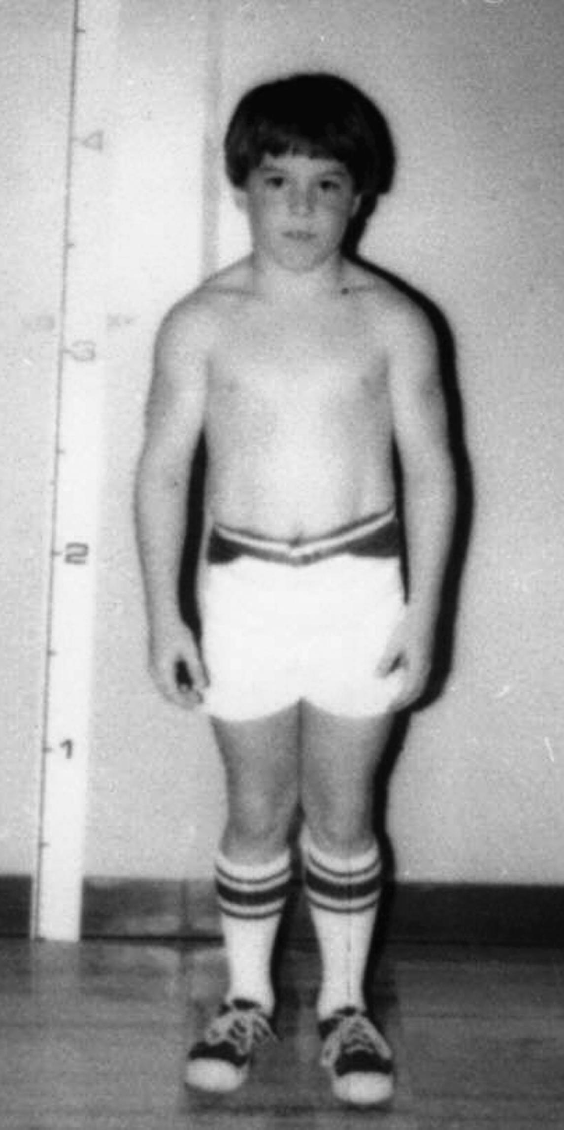 Fig. 1.7, A child with autosomal-recessive myotonia congenita.