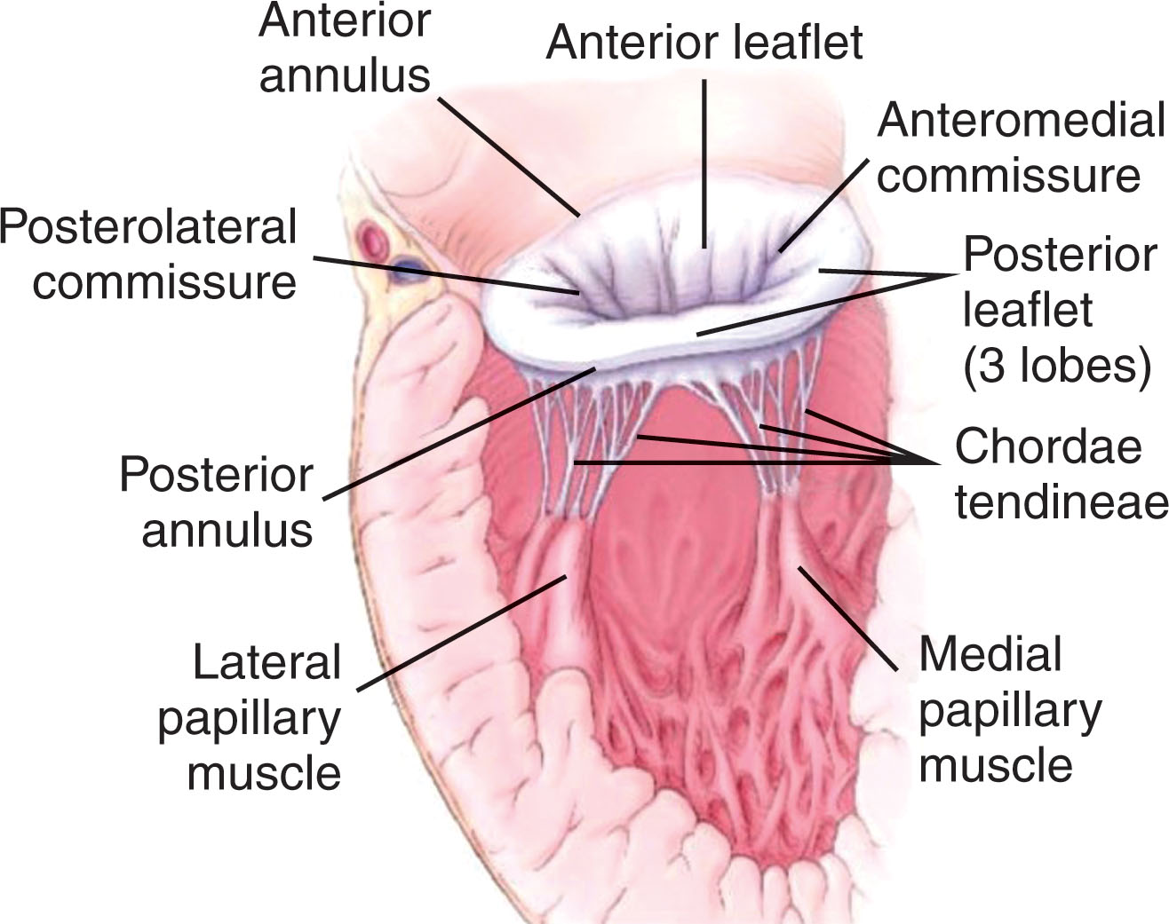 Fig. 33.1, The mitral apparatus is comprised of two leaflets (anterior and posterior), anterior and posterior annulus, posterolateral and anteromedial commissure, chordae tendineae, and lateral and medial papillary muscles.