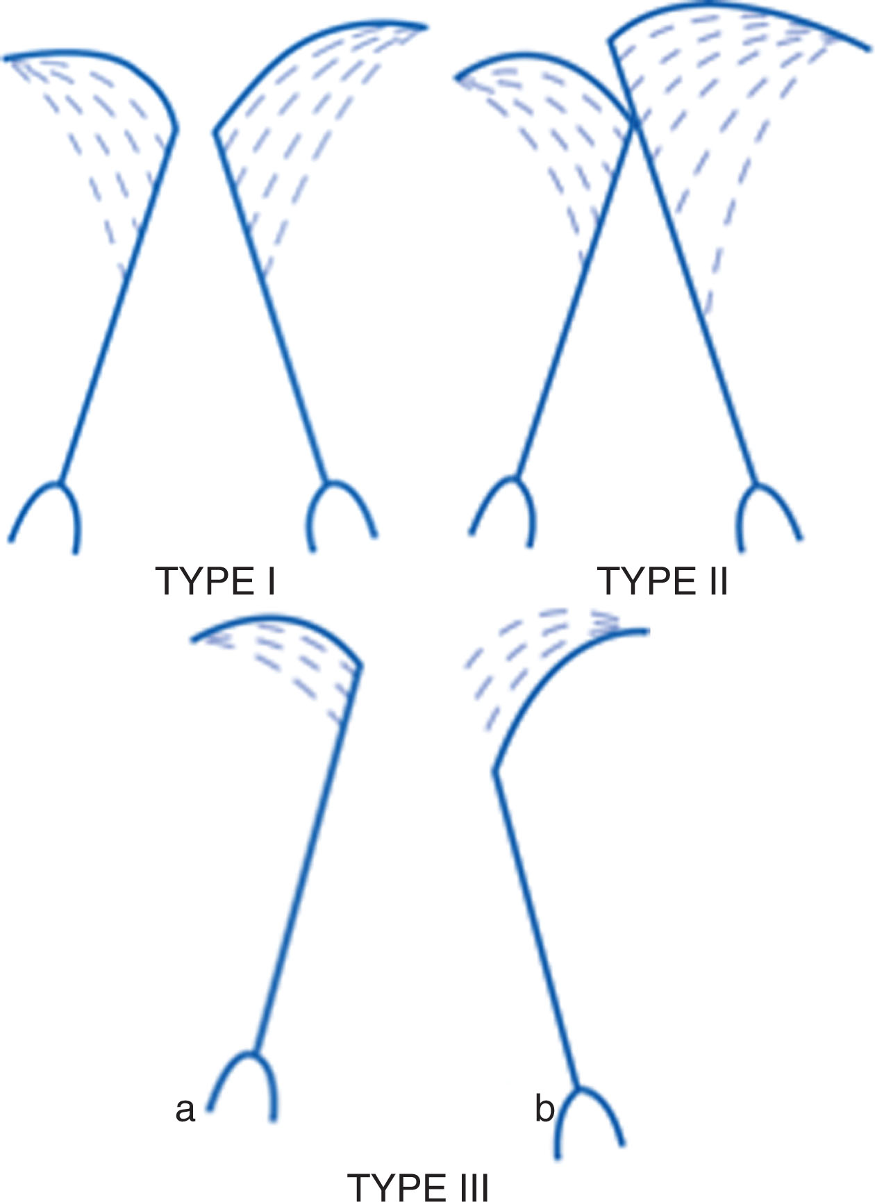 Fig. 33.3, The functional classification of mitral regurgitation is known as Carpentier’s classification with three specific types. Type I shows normal leaflet motion with the mitral regurgitation due to annular dilation, perforation, or cleft; type II shows excessive leaflet motion due to mitral valve prolapse or chordal rupture; and type III shows restricted leaflet motion (two forms, a and b ) due to rheumatic heart disease or dilated cardiomyopathy.