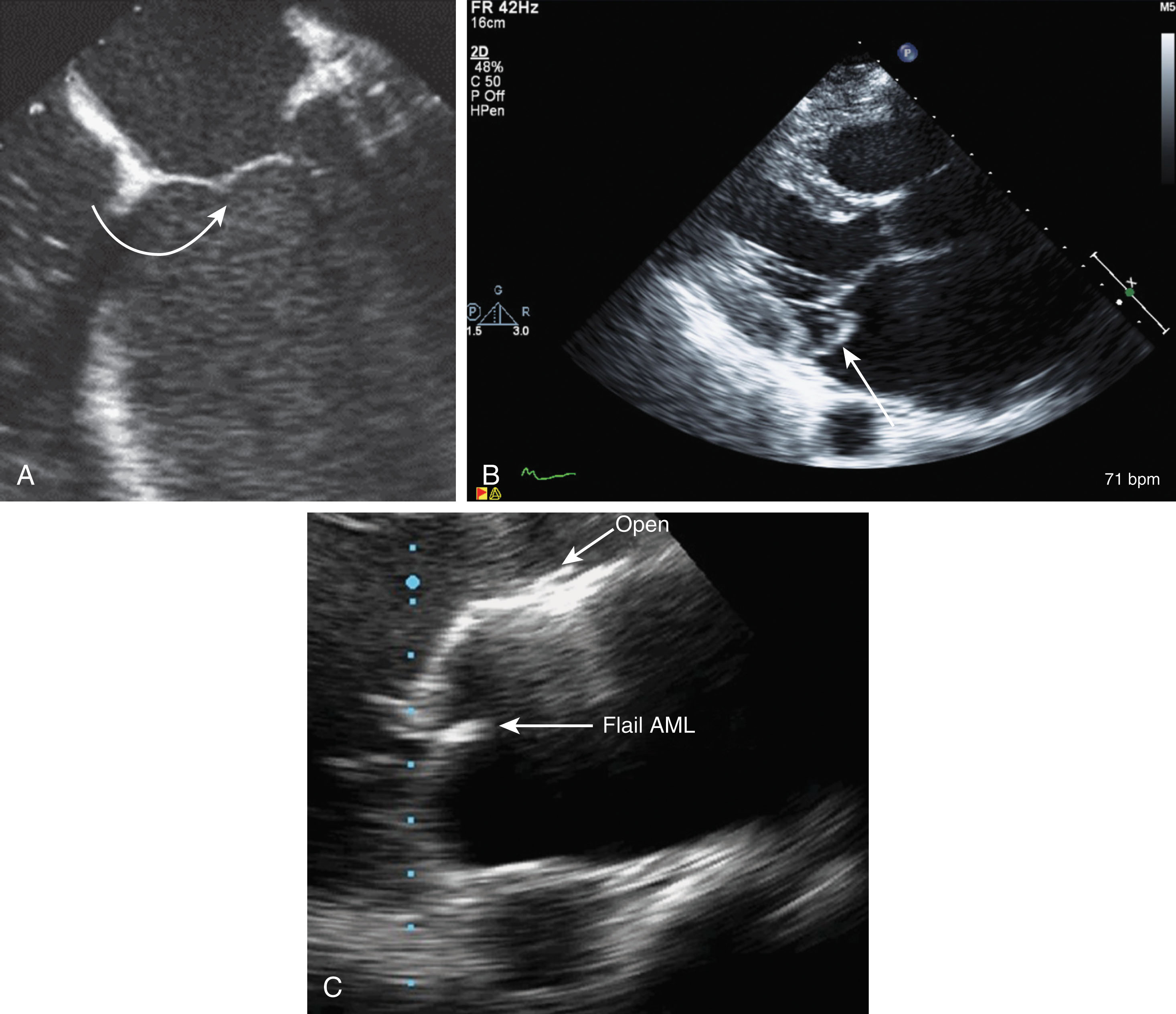 Fig. 33.4, (A) Tenting of the mitral leaflets (arrow) . (B) Mitral valve prolapse of the posterior leaflet (arrow) . (C) Flail anterior leaflet of the mitral valve (AML).