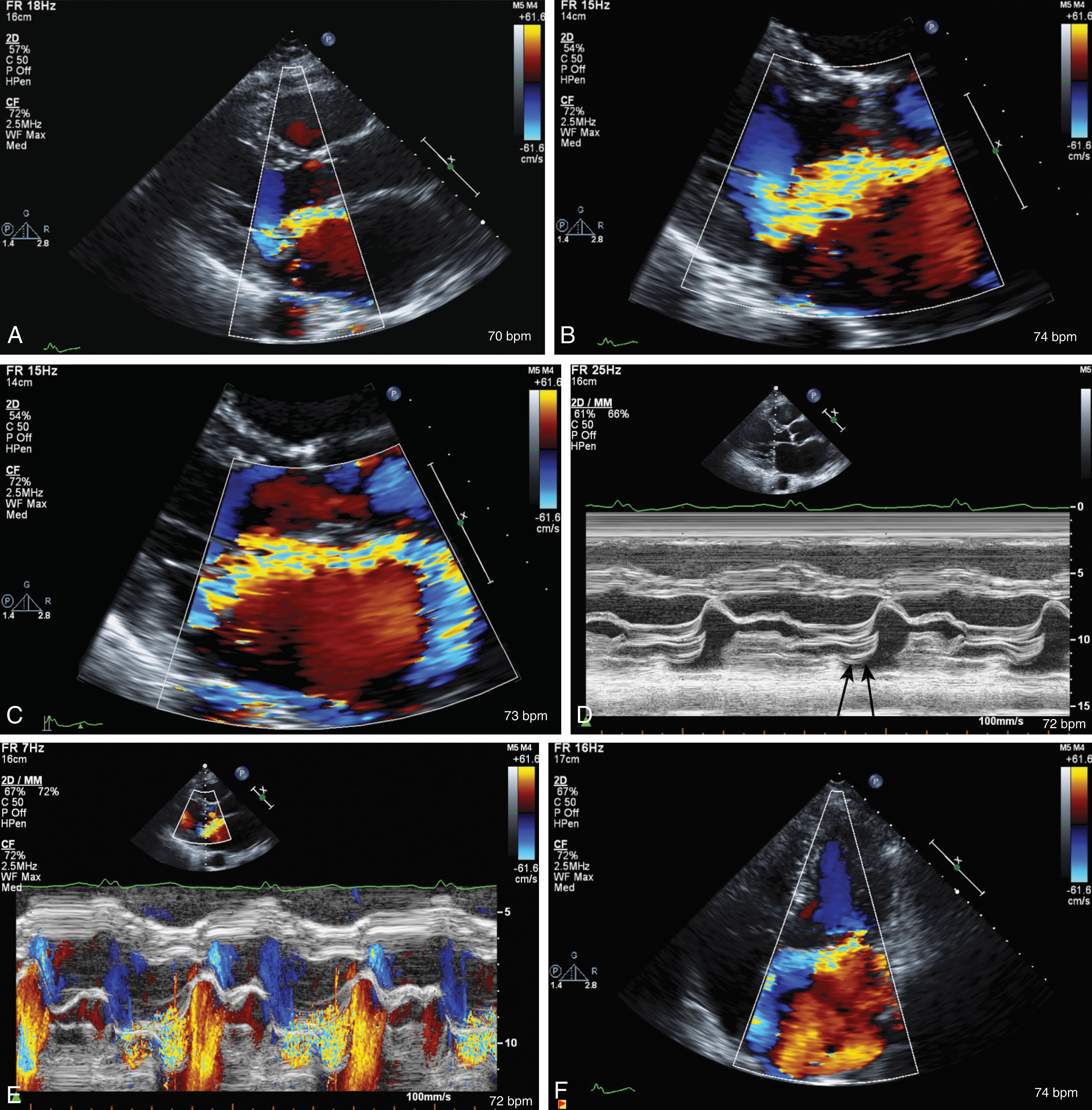 Fig. 33.5, (A) Parasternal long-axis view (PLAX) shows the anterior direction of the mitral regurgitation. (B) Zoom PLAX of the mitral regurgitation. (C) The regurgitant jet flows to the base of the atria. (D) M-mode demonstrating the midsystolic prolapse of the posterior leaflet mitral valve (arrow) . (E) M-color Doppler of the regurgitant jet. (F) Four-chamber view of the posterior-directed jet.