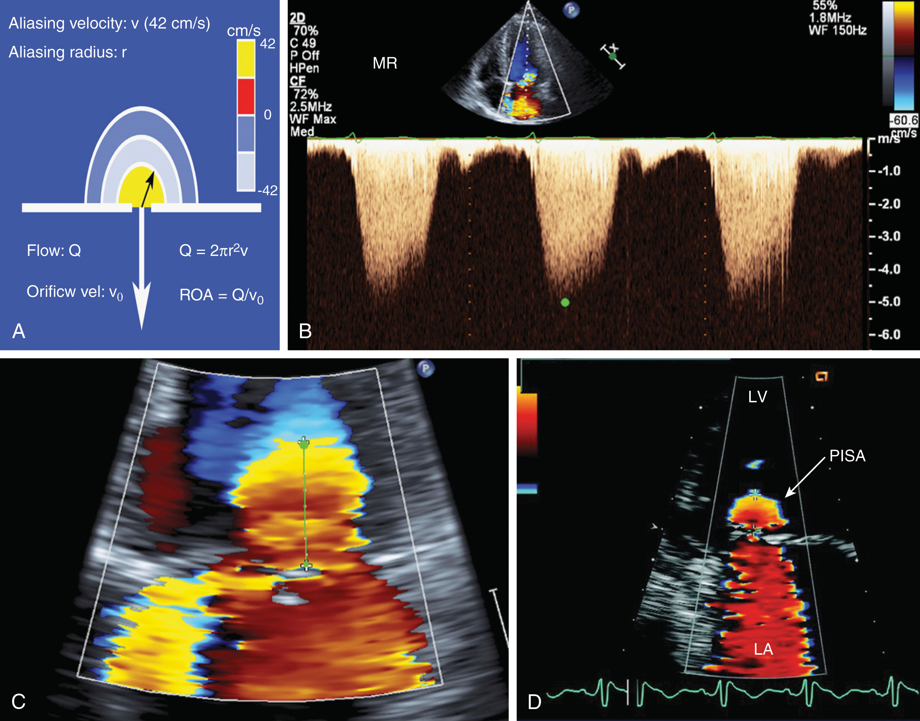 Fig. 33.6, (A) Proximal isovelocity surface area (PISA) method: flow at the surface of the hemisphere equals flow through the regurgitant orifice. (B) Measurement of the mitral regurgitant jet with continuous wave Doppler. (C–D) Measure the hemisphere of the PISA. LV , Left ventricle; MV , mitral valve.