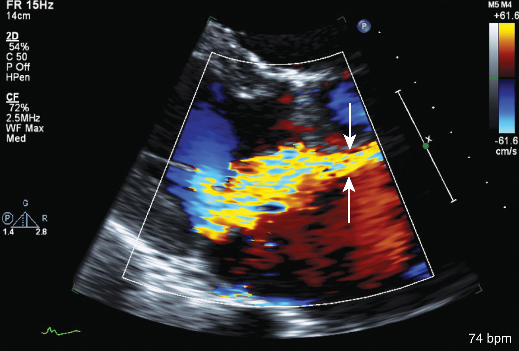 Fig. 33.7, The vena contracta should be measured in the parasternal long-axis view at the narrowest portion of the regurgitant jet, just after the orifice (arrows) .