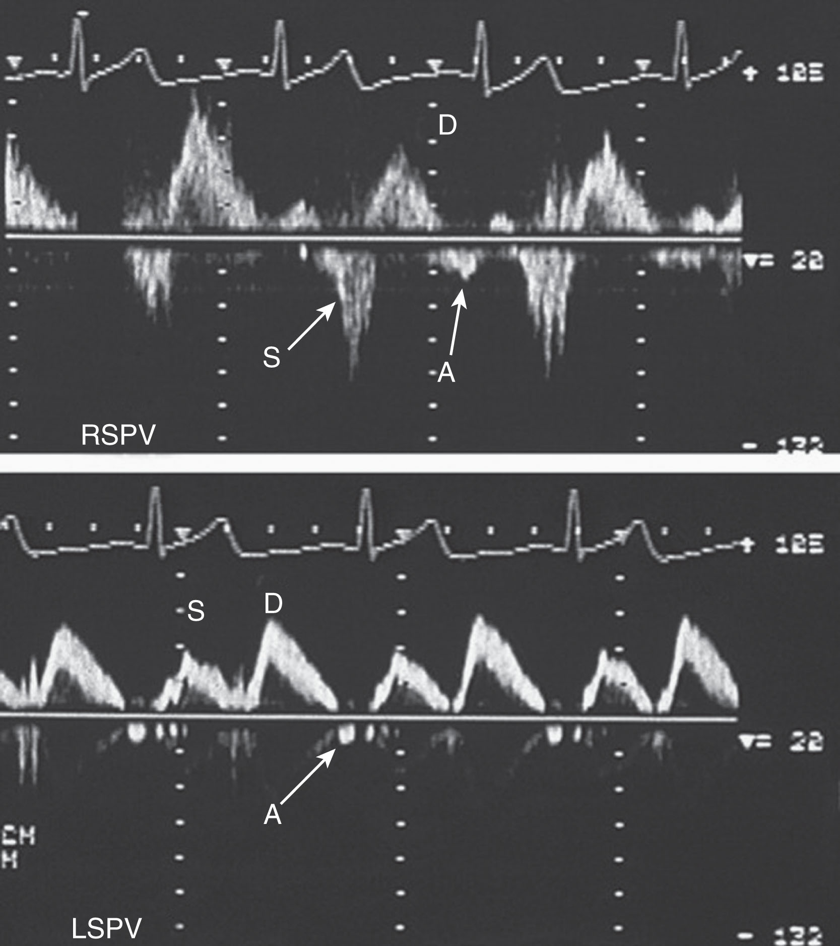 Fig. 33.8, The blunting of the systolic component of the pulmonary venous inflow indicates moderate mitral regurgitation. The systolic flow reversal indicates severe mitral regurgitation. LSPV , Left superior pulmonary vein; RSPV , right superior pulmonary vein.