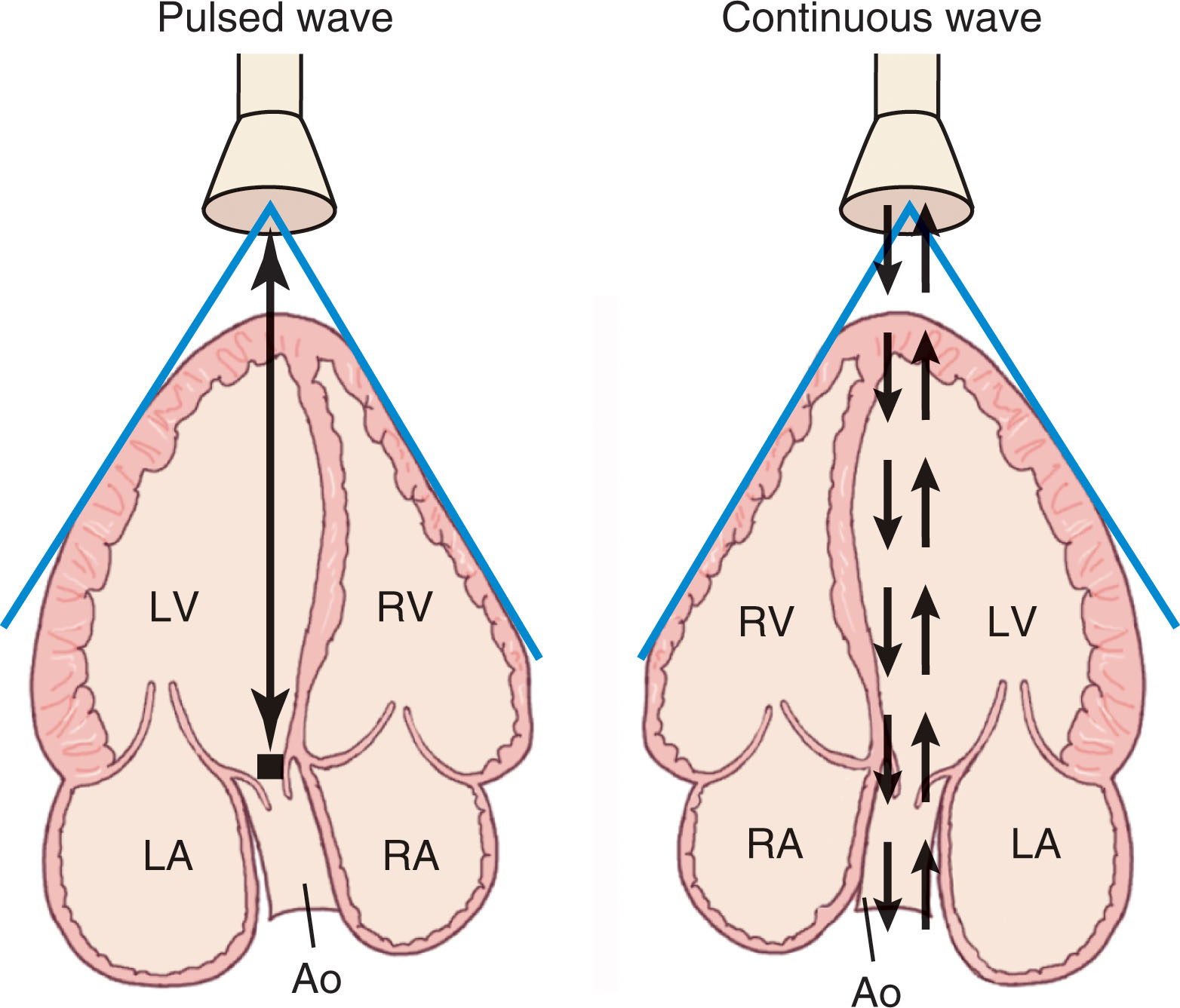 Fig. 32.11, Pulsed wave and continuous wave Doppler echocardiography with the transducer placed in the point of maximal impulse at the apex of the heart. Ao , Aorta; LA , left atrium; LV , left ventricle; RA , right atrium; RV , right ventricle.