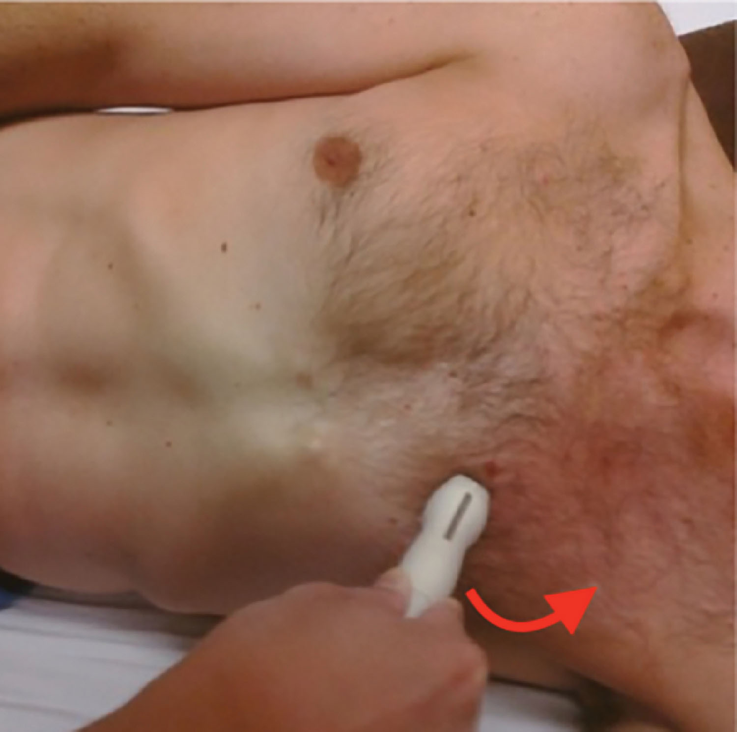 Fig. 32.3, In the initial echocardiographic study, the sonographer should hold the transducer in their left hand with their fingers near the base of the probe. The notch should be upright for the parasternal long-axis view with slight rotation directed from the right shoulder to the left hip.