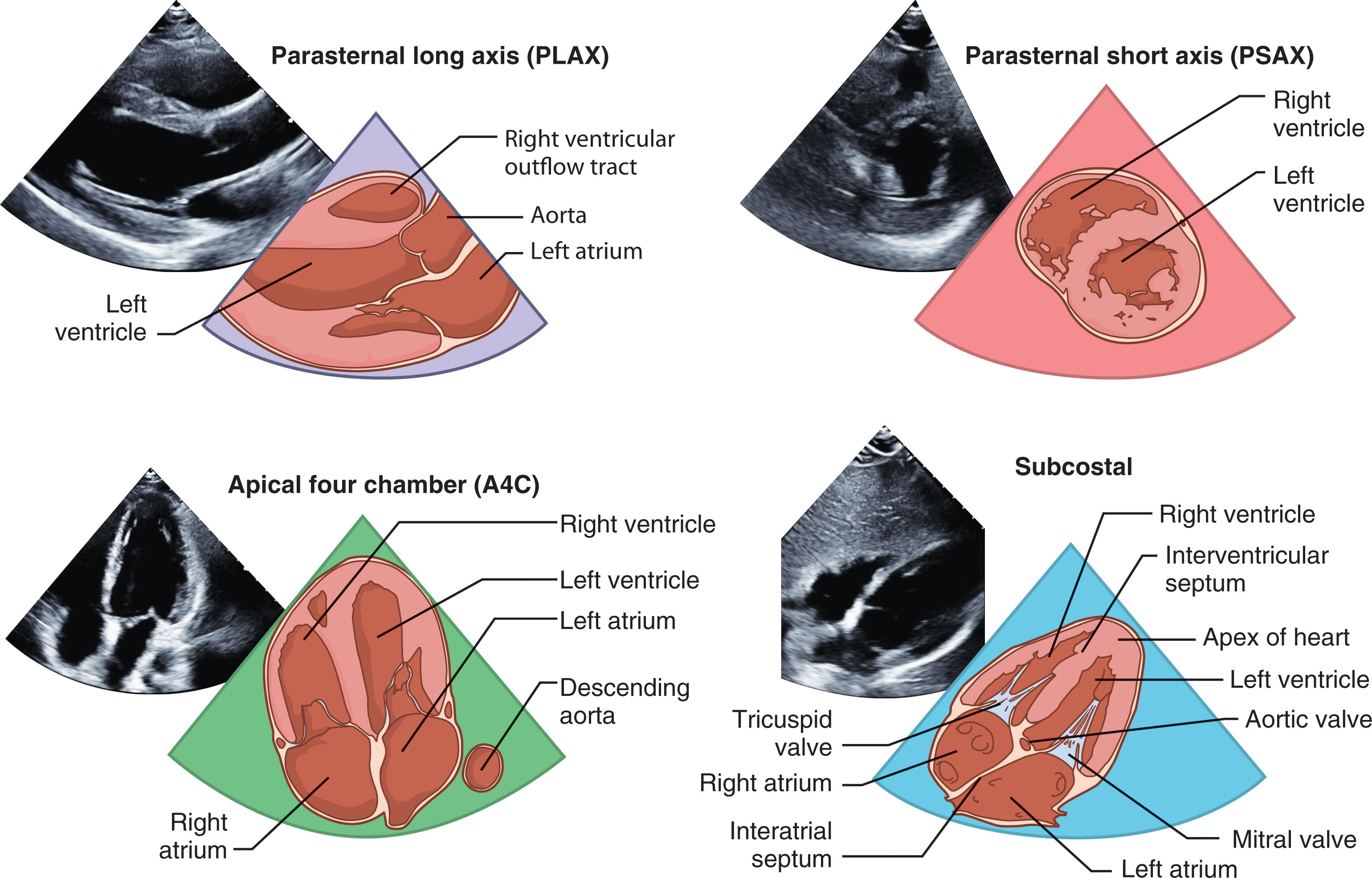 Fig. 32.4, (A) The heart is examined from the parasternal long and short axis, the apical, subcostal, and suprasternal notch. (B) The four transducer positions for the echocardiogram: Suprasternal, transducer is placed in the suprasternal notch; subcostal, transducer is placed near the midline and beneath the costal margin; apical, transducer is placed at the point of maximal impulse cardiac apex; and parasternal, transducer is placed just left of the sternum about the fourth intercostal space.