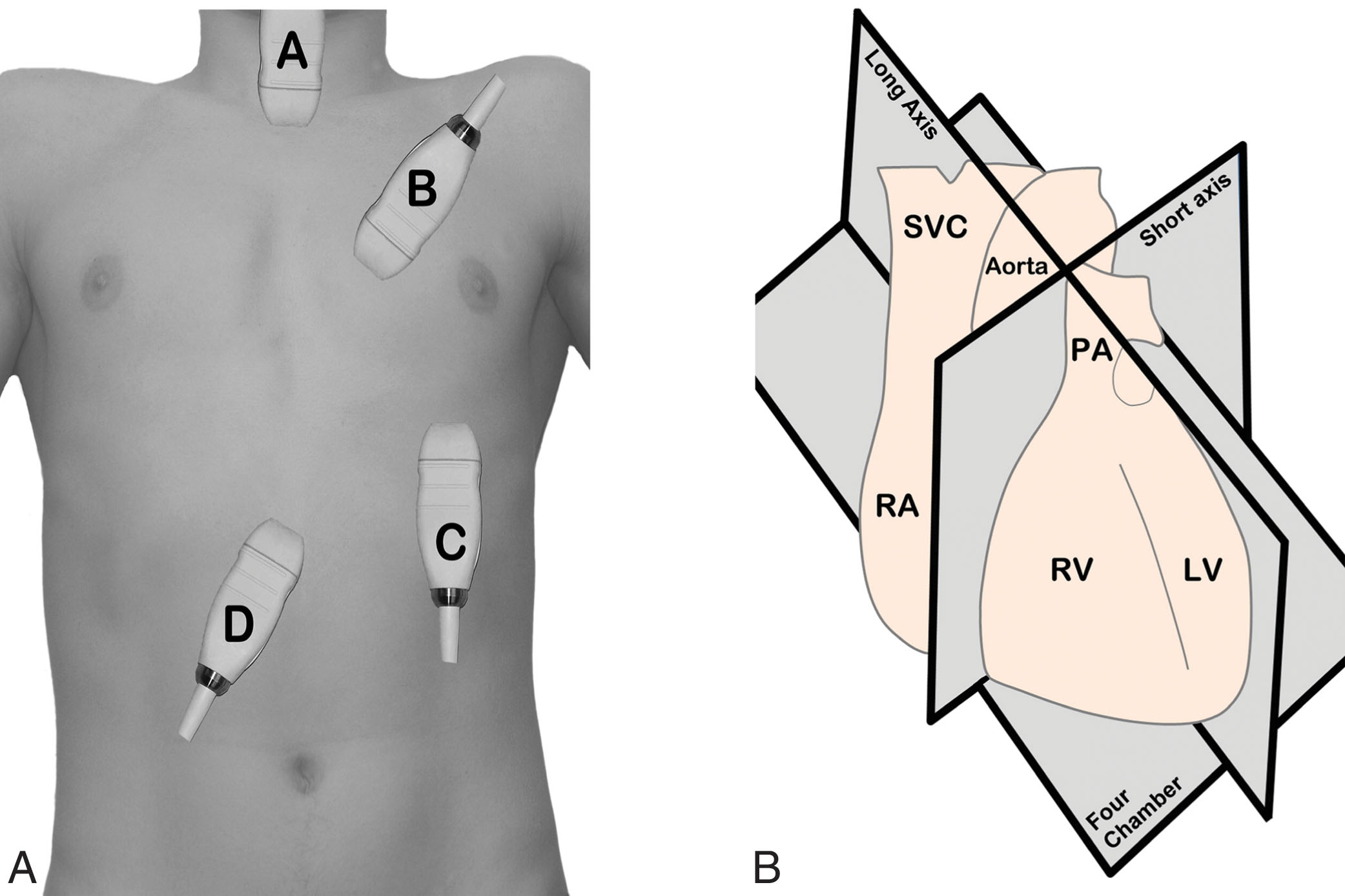 Fig. 32.5, (A) Parasternal long axis transects the heart perpendicular to the dorsal and ventral surfaces of the body and parallel with the long axis of the heart. Parasternal short axis transects the heart perpendicular to the dorsal and ventral surfaces of the body and perpendicular to the long axis of the heart.