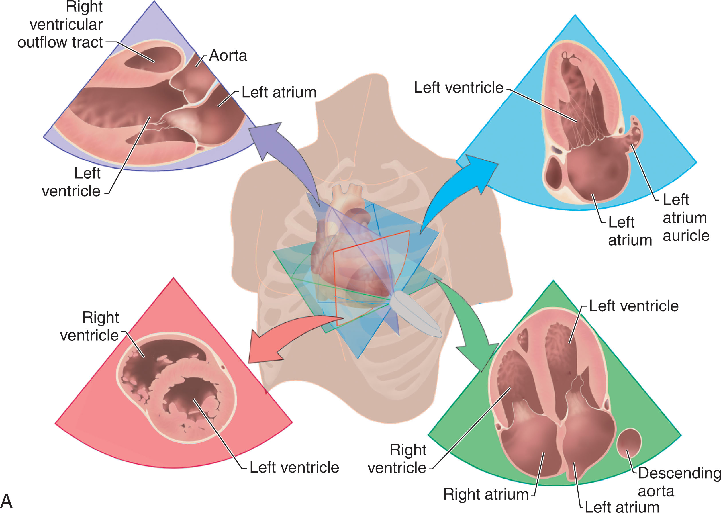 Fig. 32.6, (A) The patient is placed in the left lateral decubitus position, and the transducer is placed over the cardiac apex (at the point of maximal impulse). (B) In the four-chamber view , the probe transects the heart approximately parallel with the dorsal and ventral surfaces of the body. (C) In the two-chamber view , the probe is rotated 90 degrees. (D) For the three-chamber view, a slight medial rotation is made. AMLV , Anterior leaflet mitral valve; AV , aortic valve; CT , chordae tendineae; IVS , interventricular septum; LA , left atrium; LVOT , left ventricular outflow tract; LV , left ventricle; PLMV , posterior leaflet mitral valve; PM pap , posterior papillary muscle; RA , right atrium; RV , right ventricle.