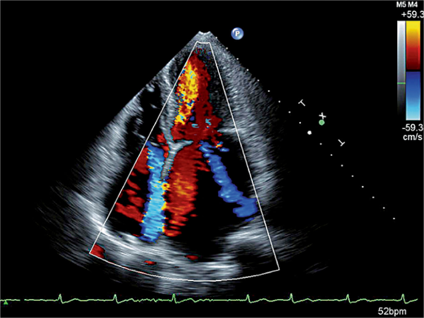 Fig. 32.7, Apical four-chamber view with color.