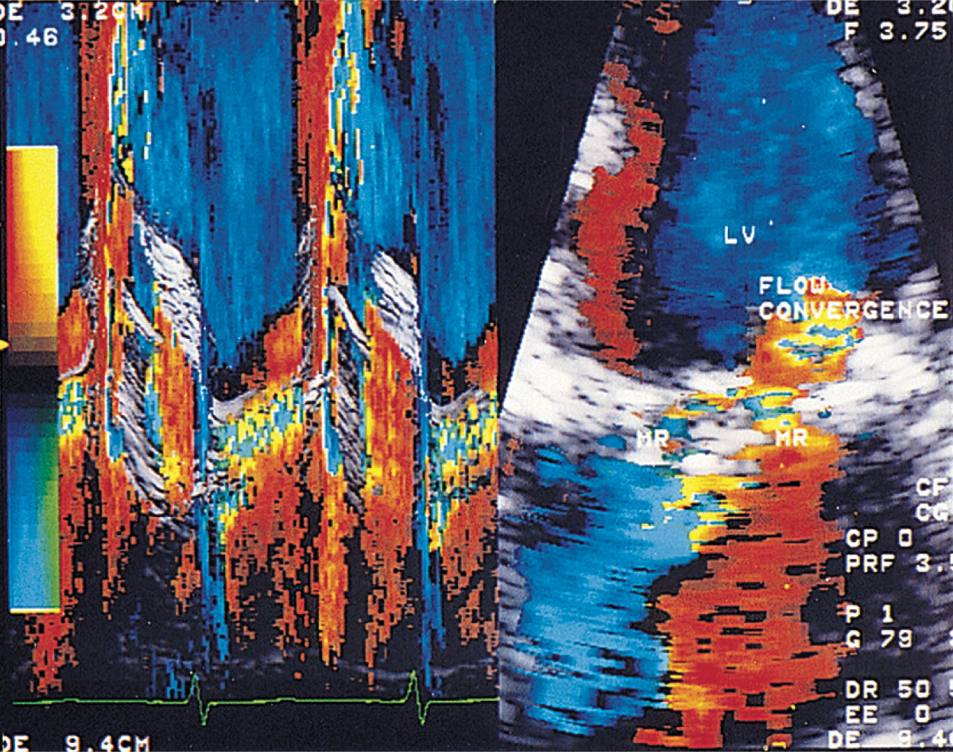 Fig. 32.8, Flow convergence as imaged in the four-chamber view and M-mode/color flow mapping image. The red inflow is from the pulmonary veins into the left atrium, the blue is swirling flow within the left atrium, and the multicolored flow at the level of the mitral valve is regurgitant flow. LV , Left ventricle; MR , mitral regurgitation.