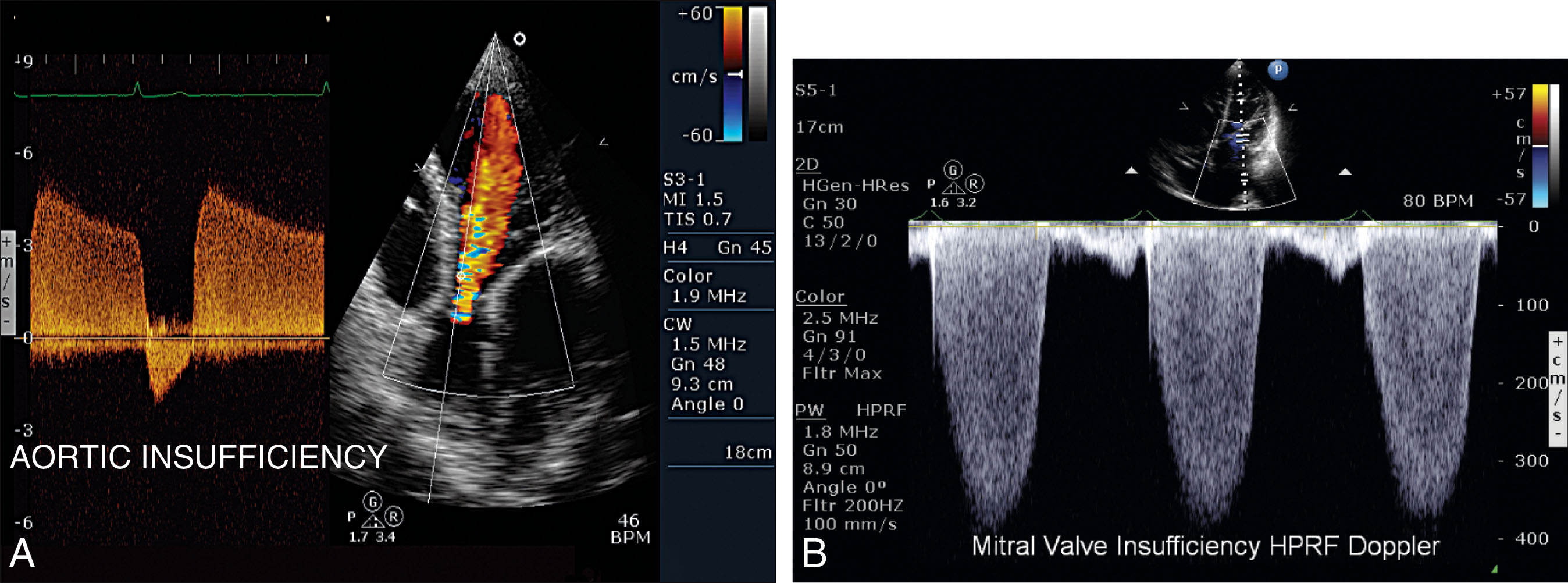 Fig. 32.9, (A) Flow above the baseline represents forward flow, as seen in this patient with aortic insufficiency. (B) Flow below the baseline represents flow moving away from the transducer, as seen in this patient with mitral regurgitation.