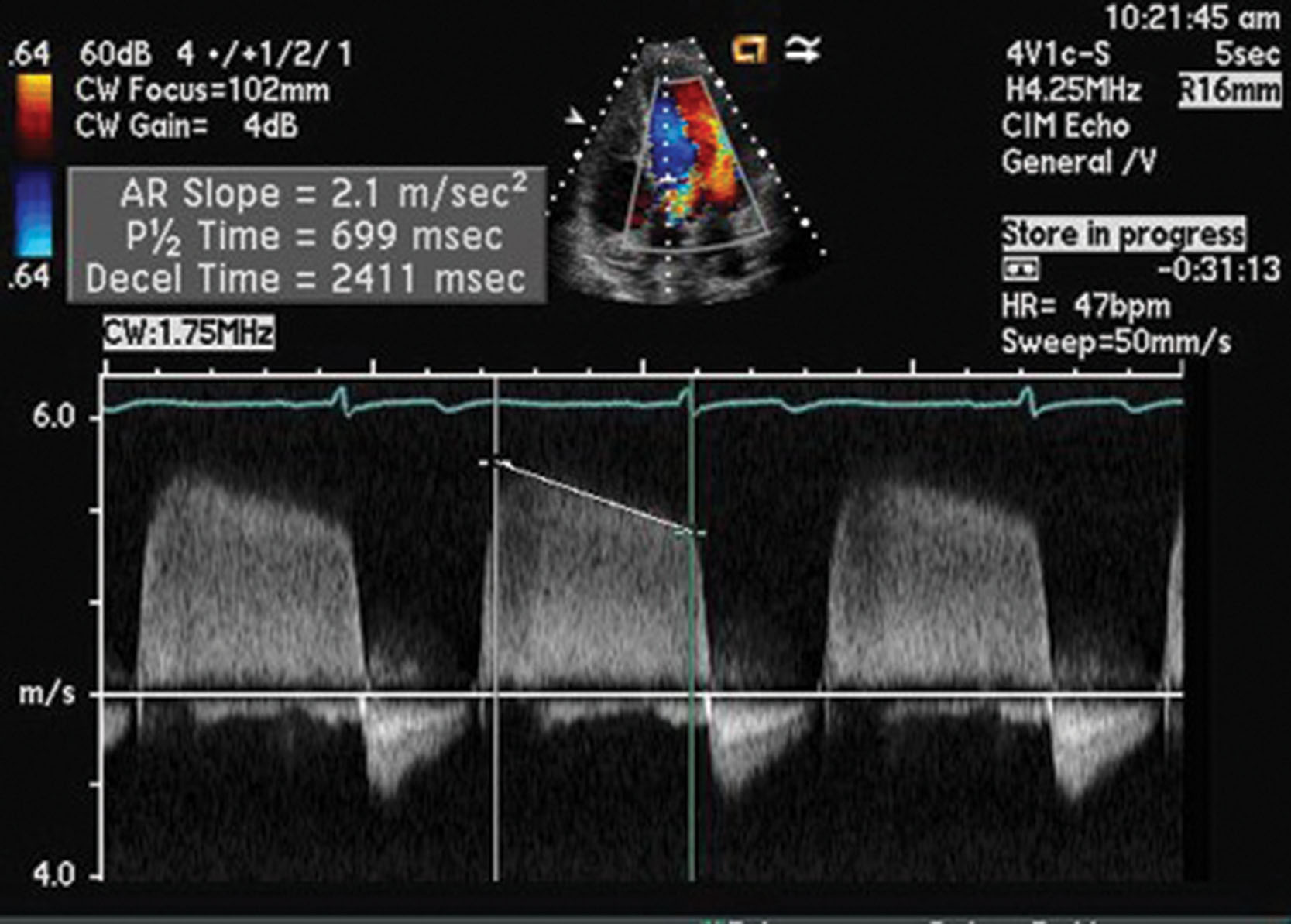 Fig. 32.10, The spectral analysis waveform allows the sonographer to store a graphic display of what the audio signal is recording because it provides a representation of blood flow velocities over time. The velocity on the vertical axis is measured in centimeters per second or meters per second, and time is shown on the horizontal axis.