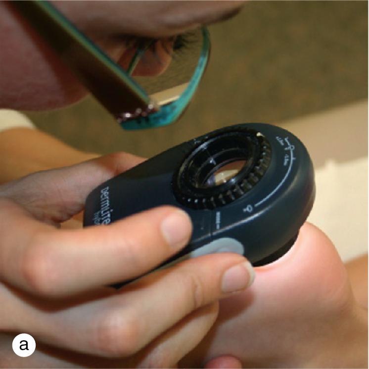 Fig. 1.2, Examination of pigmented nevi with (a) handheld DermLite dermatoscope by 3Gen, (b) DermLite DL4W dermatoscope by 3Gen, and (c) Welch Allyn otoscope.