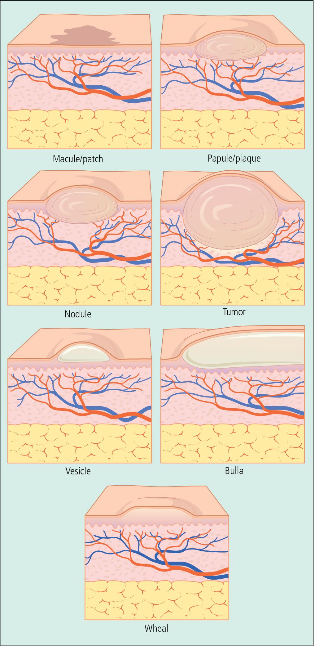 Fig. 1.4, Primary skin lesions. Macule: a small (usually 1 cm), flat lesion showing an alteration in color or tone. Large macule is a patch. Papule: a small (1 cm), sharply circumscribed, elevated lesion. An elevated lesion over 1 cm is referred to as a plaque. Nodule: a soft or solid mass in the dermis or subcutaneous fat. Tumor: a large nodule, localized and palpable, of varied size and consistency. Vesicle: a blister containing transparent fluid. Bulla: a large blister. Wheal: an evanescent, edematous, circumscribed, elevated lesion that appears and disappears quickly.