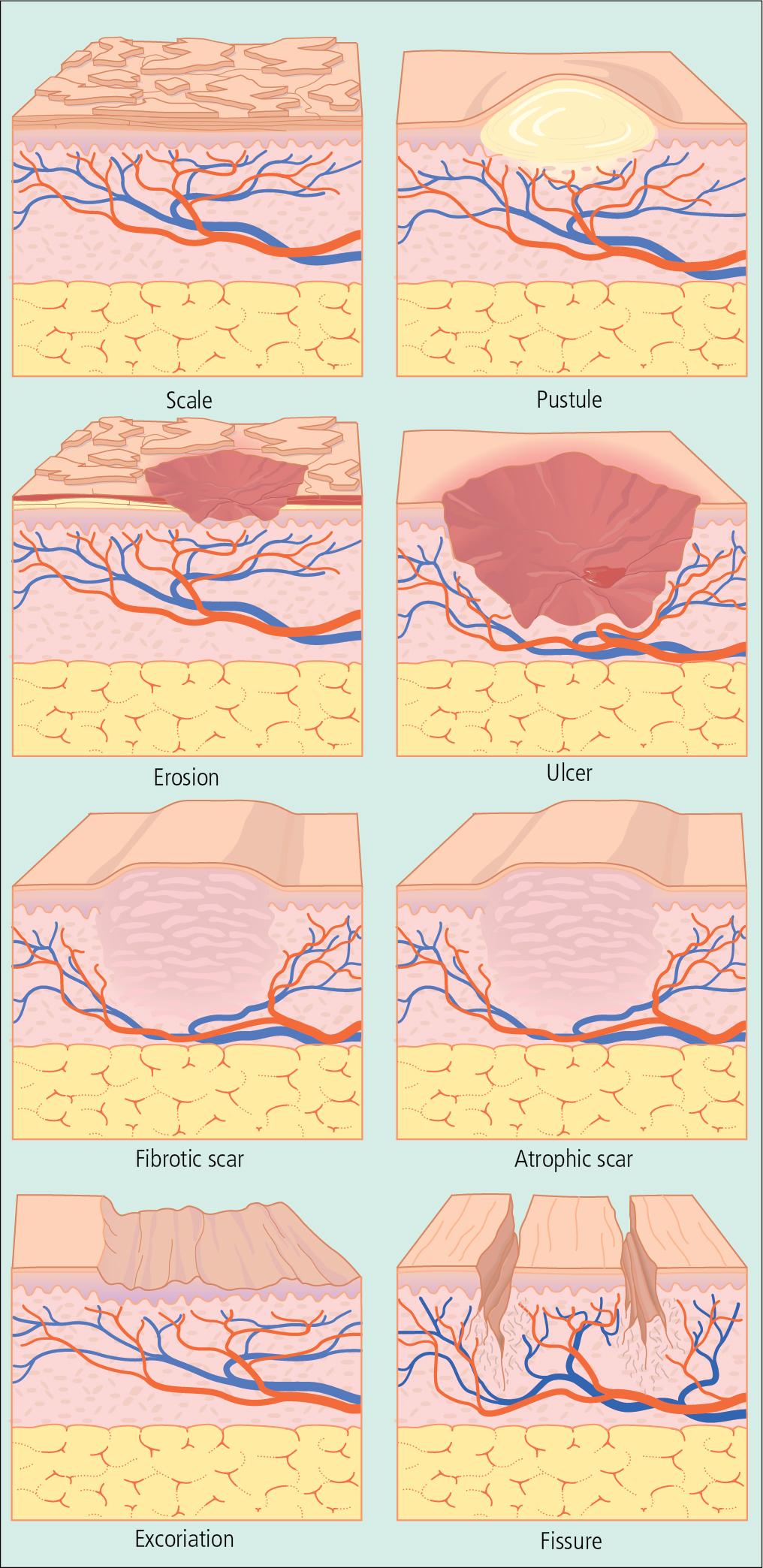 Fig. 1.5, Secondary skin lesions. Scale: dry and/or greasy fragments of adherent epidermis. Pustule: a sharply circumscribed lesion containing free pus. Crust: a dry mass of exudate from erosions or ruptured vesicles/pustules, consisting of serum, dried blood, scales, and pus. Erosion: well-defined partial-thickness loss of epidermis. Ulcer: a clearly defined, full-thickness loss of epidermis that may extend into the subcutis. Scar: a permanent skin change resulting from new formation of connective tissue after destruction of the epidermis and cutis. When the loss of dermis and/or fat is prominent, the lesion may be atrophic. Fibrosis may result in firm, thickened papules or plaques. Excoriation: any scratch mark on the surface of the skin. Fissure: any linear crack in the skin, usually accompanied by inflammation and pain.