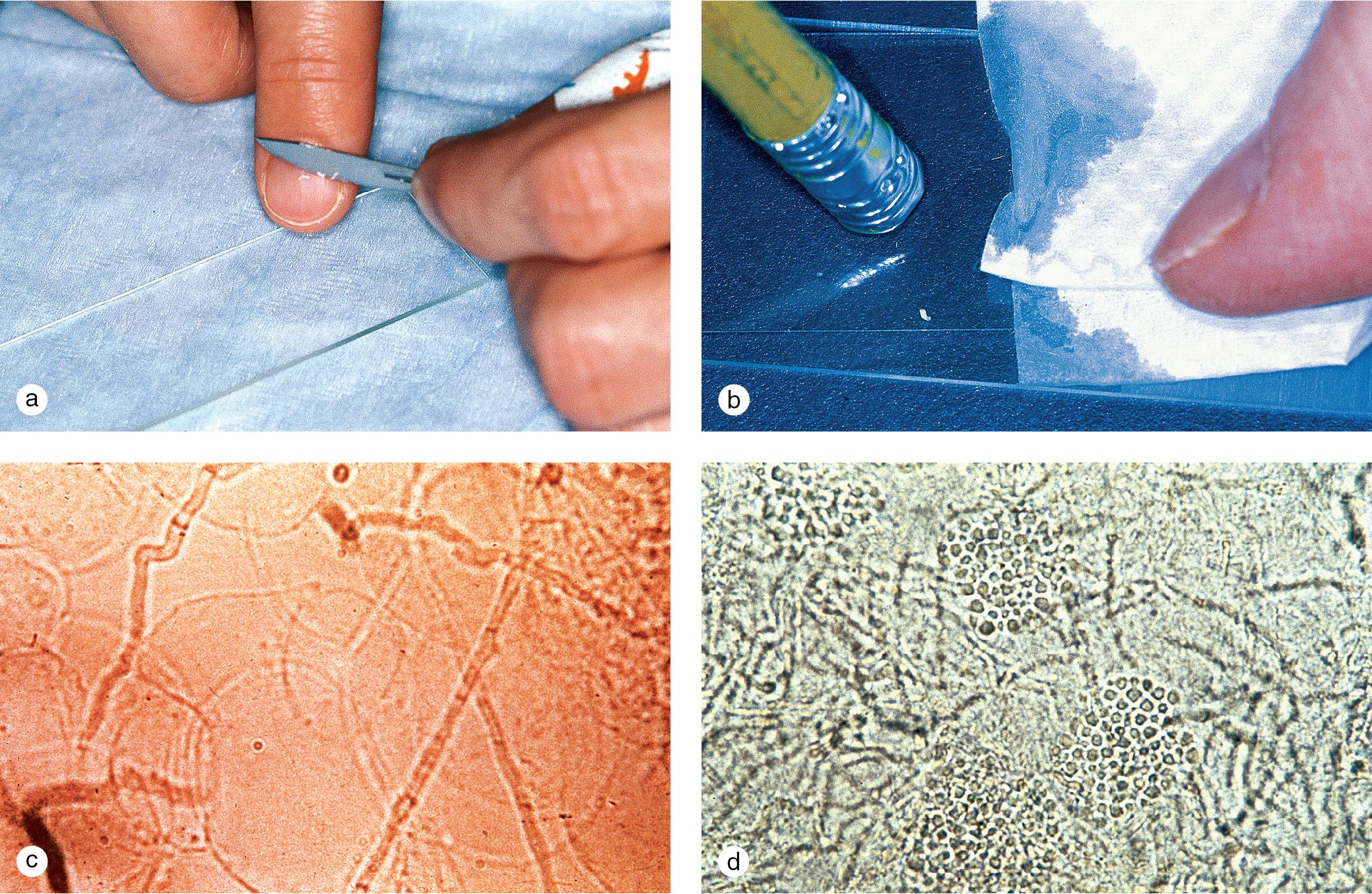 Fig. 1.6, Potassium hydroxide (KOH) preparation. (a) Small scales are scraped from the edge of the lesion onto a microscopic slide. (b) The scales are crushed to form a thin layer of cells in order to visualize the fungus easily. (c) In this positive KOH preparation of skin scrapings, fungal hyphae are seen as long septate, branching rods at the margins and center of the scales. (d) Pseudohyphae and spores typical of tinea versicolor give the appearance of spaghetti and meatballs.