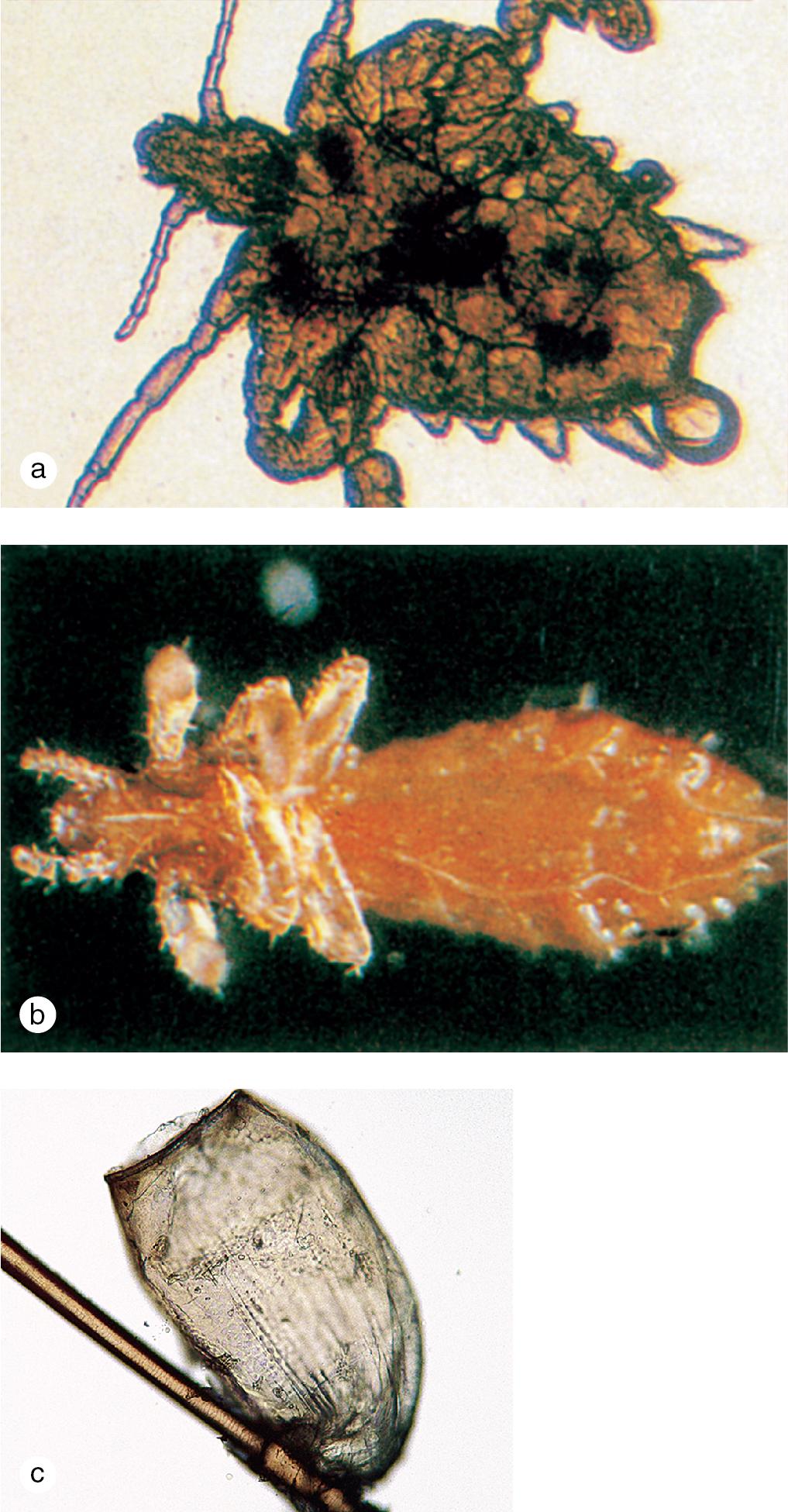 Fig. 1.8, Microscopic appearance of lice. (a) The crab louse has a short, broad body, with claws spaced far apart. (b) The head louse has a long, thin body, with claws closer together. (c) A hatched nit is tightly cemented to the hair shaft.