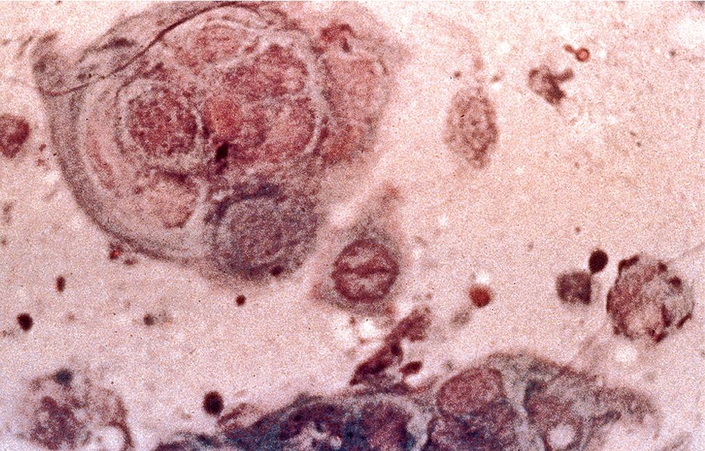 Fig. 1.9, Tzanck Smear. Note the multinucleated giant cells characteristic of viral infection with herpes simplex and varicella/zoster.