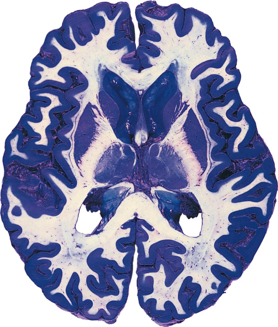 Fig. 1.9, Axial (horizontal) slice of a whole human forebrain, approximately 6-mm thick, stained by a method that differentiates between gray and white matter. Pretreatment with phenol makes the white matter resistant to the blue copper sulfate stain, so white matter appears white and gray matter appears bright blue.