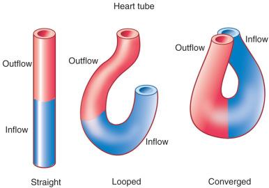 Figure 62.3, The heart tube begins as a straight midline tube with blood entering caudally via the inflow tract and exiting cranially via the outflow tract. Under normal circumstances, the tube loops to the right, creating an inflow limb (blue) and an outflow limb (red) . The distal extremities of the inflow and outflow limbs grow toward each other in a process called convergence . Convergence is necessary before septation can create a four-chambered heart.