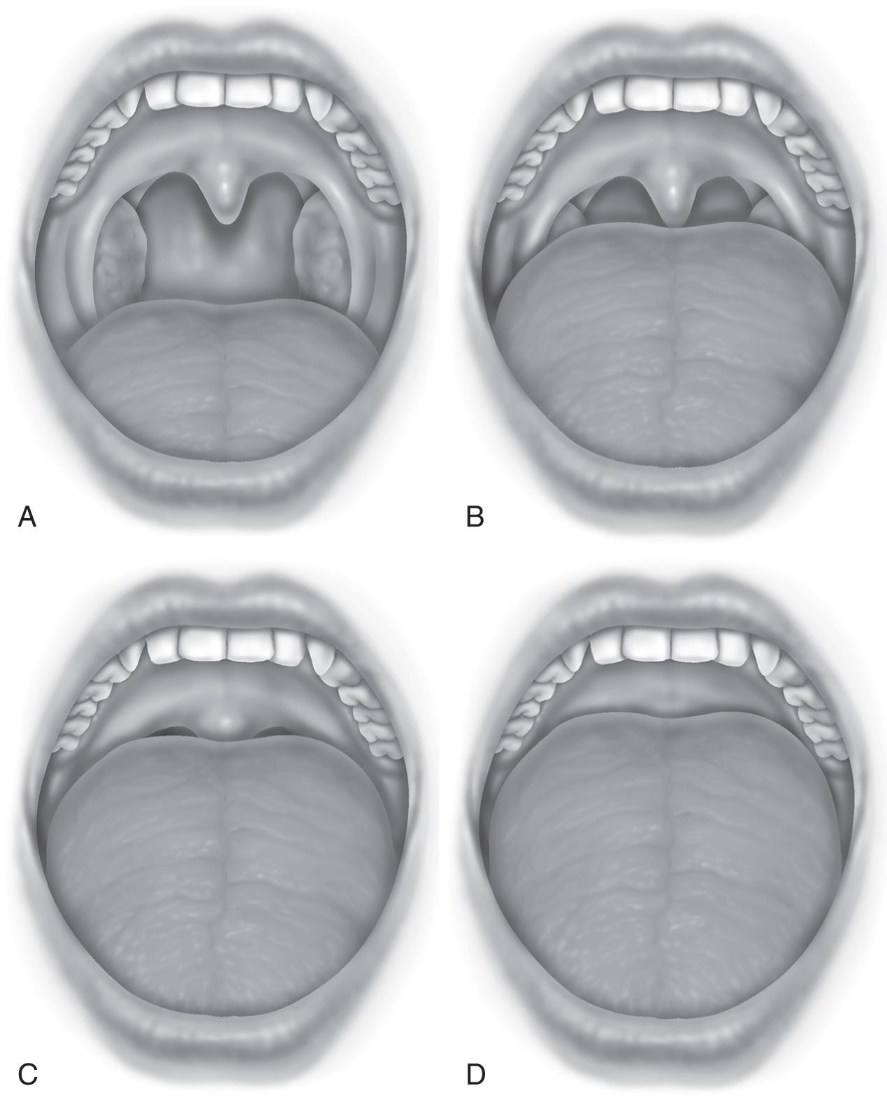 Fig. 79.1, Friedman Palate Position. A, I – Visualization of entire uvula and tonsils/tonsillar pillars. B, II – Visualization of the uvula but not tonsils. C, III – Visualization of the soft palate but not uvula. D, IV – Visualization of hard palate only.