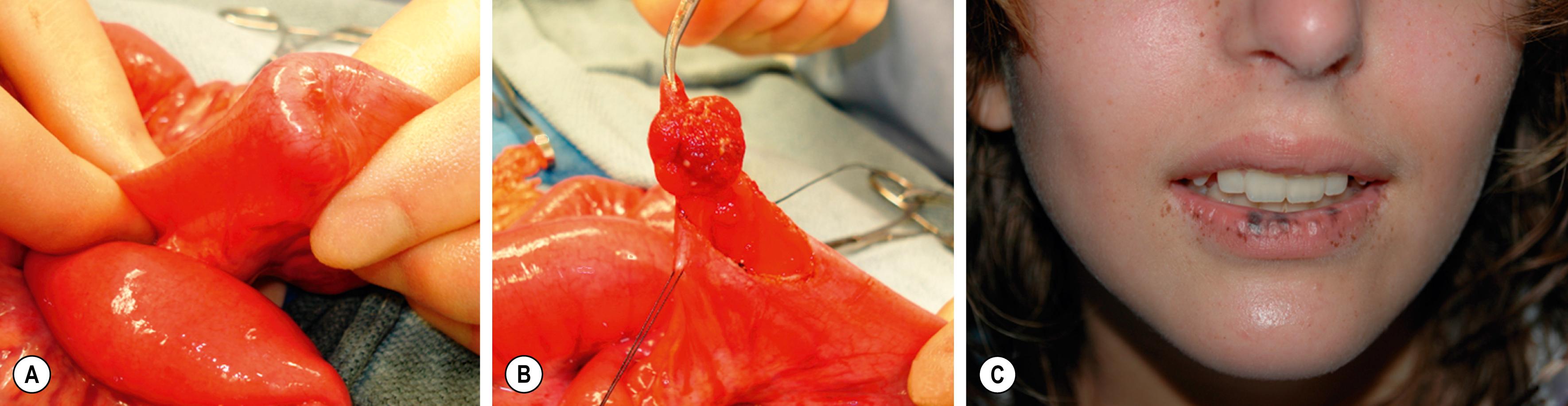 Fig. 38.1, (A) Operative view of the outside of the jejunum shows a palpable mass as the lead point of a reduced intussusception. (B) A hamartomatous polyp is characteristic of Peutz–Jeghers syndrome. (C) Mucocutaneous macular lesions are seen in this patient with Peutz–Jeghers syndrome. Note extension of the pigmentation beyond the vermilion border.