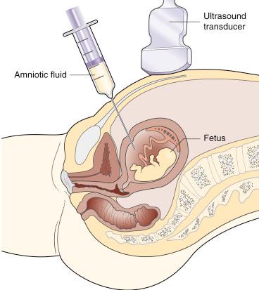 • Fig. 23.1, Schematic illustration of amniocentesis being performed under direct, continuous ultrasound scanning (sector transducer, 3.5 MHz).