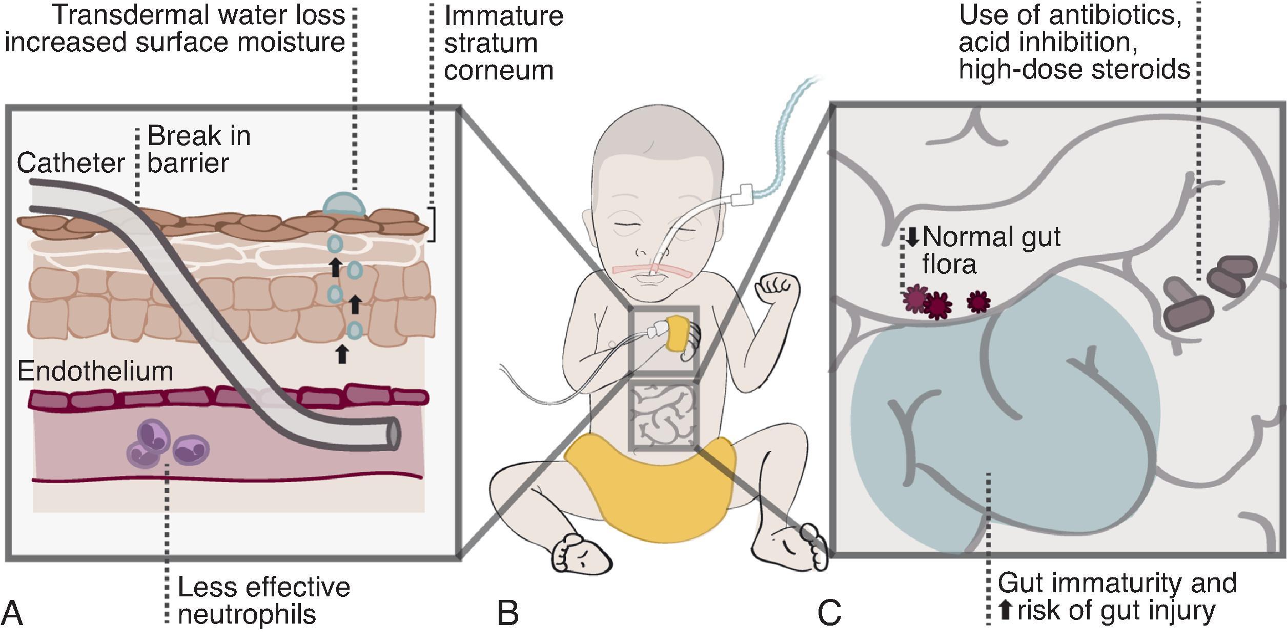 Fig. 35.2, Risk Factors for Invasive Candida Infections in Intubated Preterm Infant.