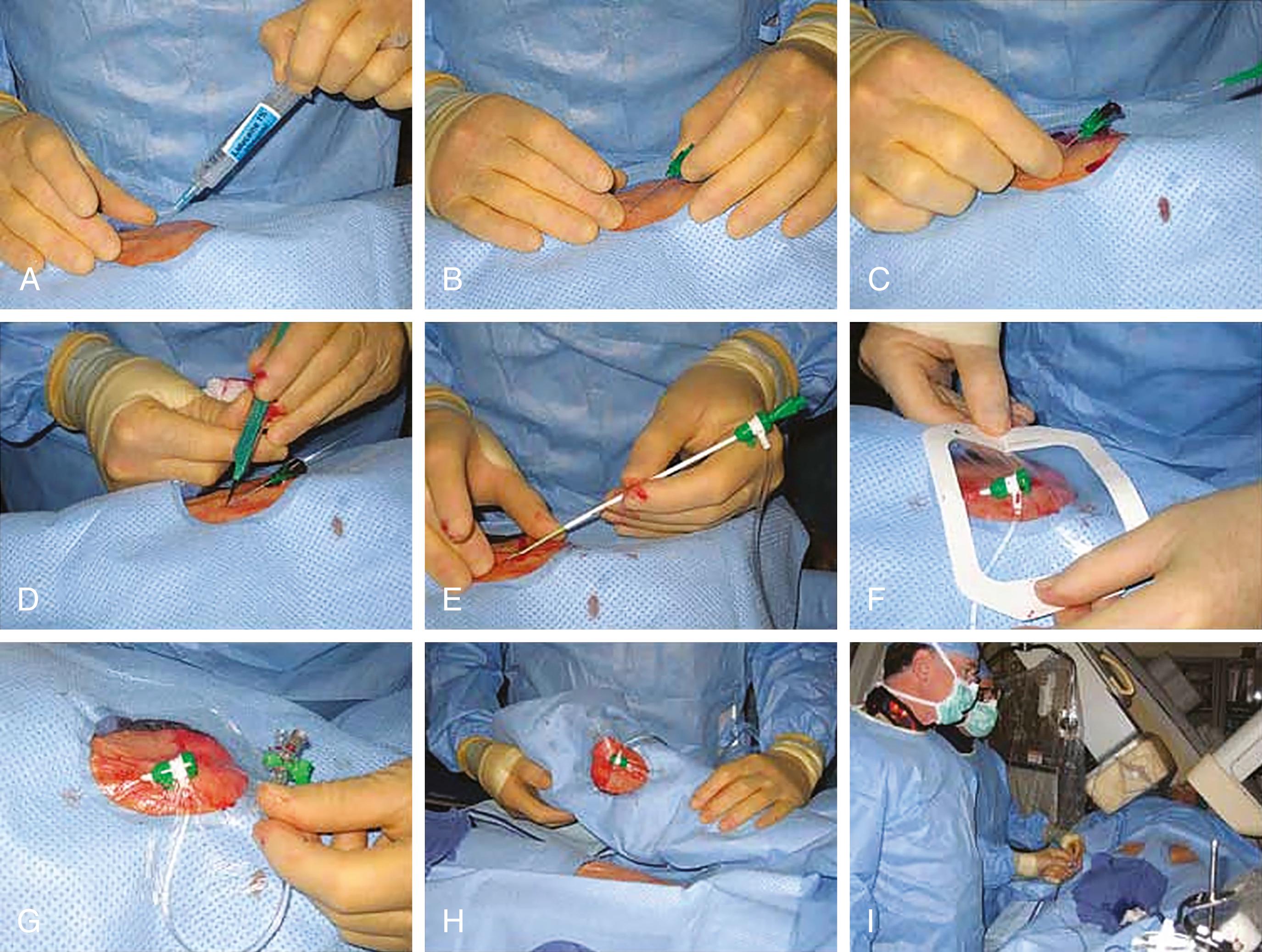 FIGURE 22.1, Radial artery access and sheath introduction.