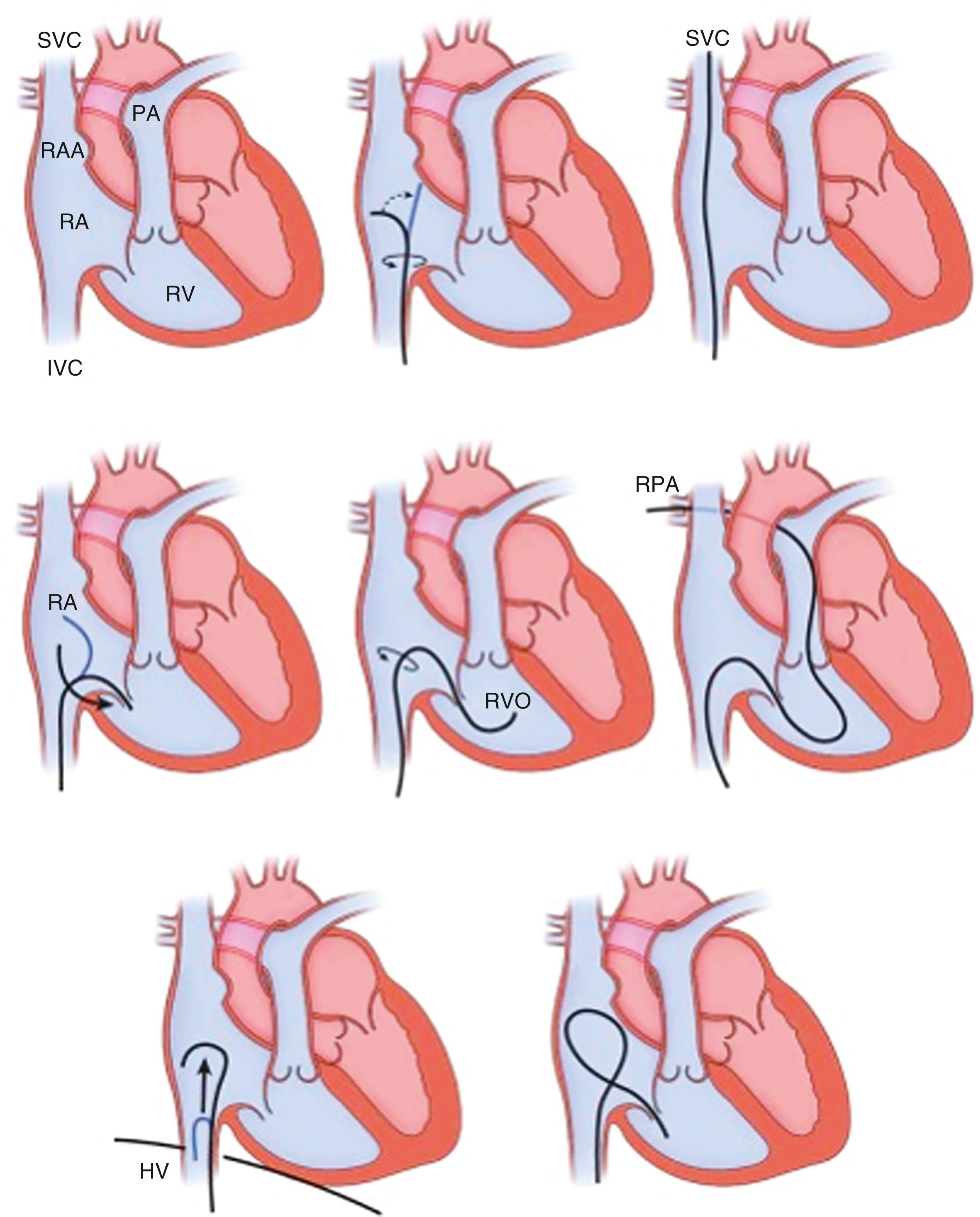 FIGURE 22.11, Right-heart catheterization via the femoral venous approach.