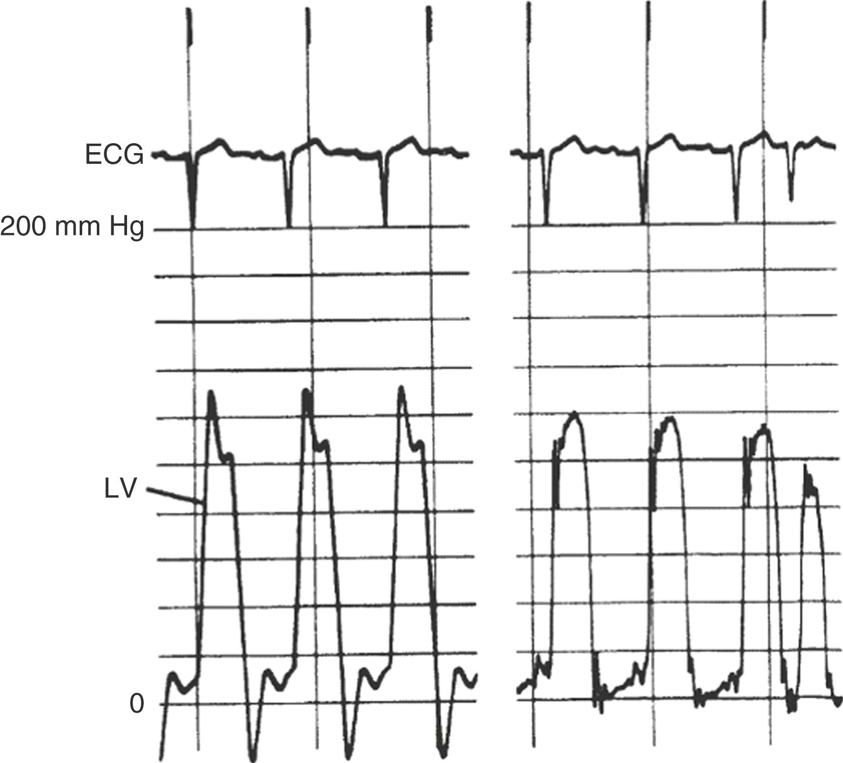 FIGURE 22.12, Left ventricular (LV) pressure with a 7F pigtail catheter using fluid-filled transducers. Left panel demonstrates “ringing” artifact with overshoot of the pressure signal during ejection and an exaggerated negative response during relaxation. On the right, a correctly damped LV pressure signal with minimal ringing during diastasis and no overshoot during systole.