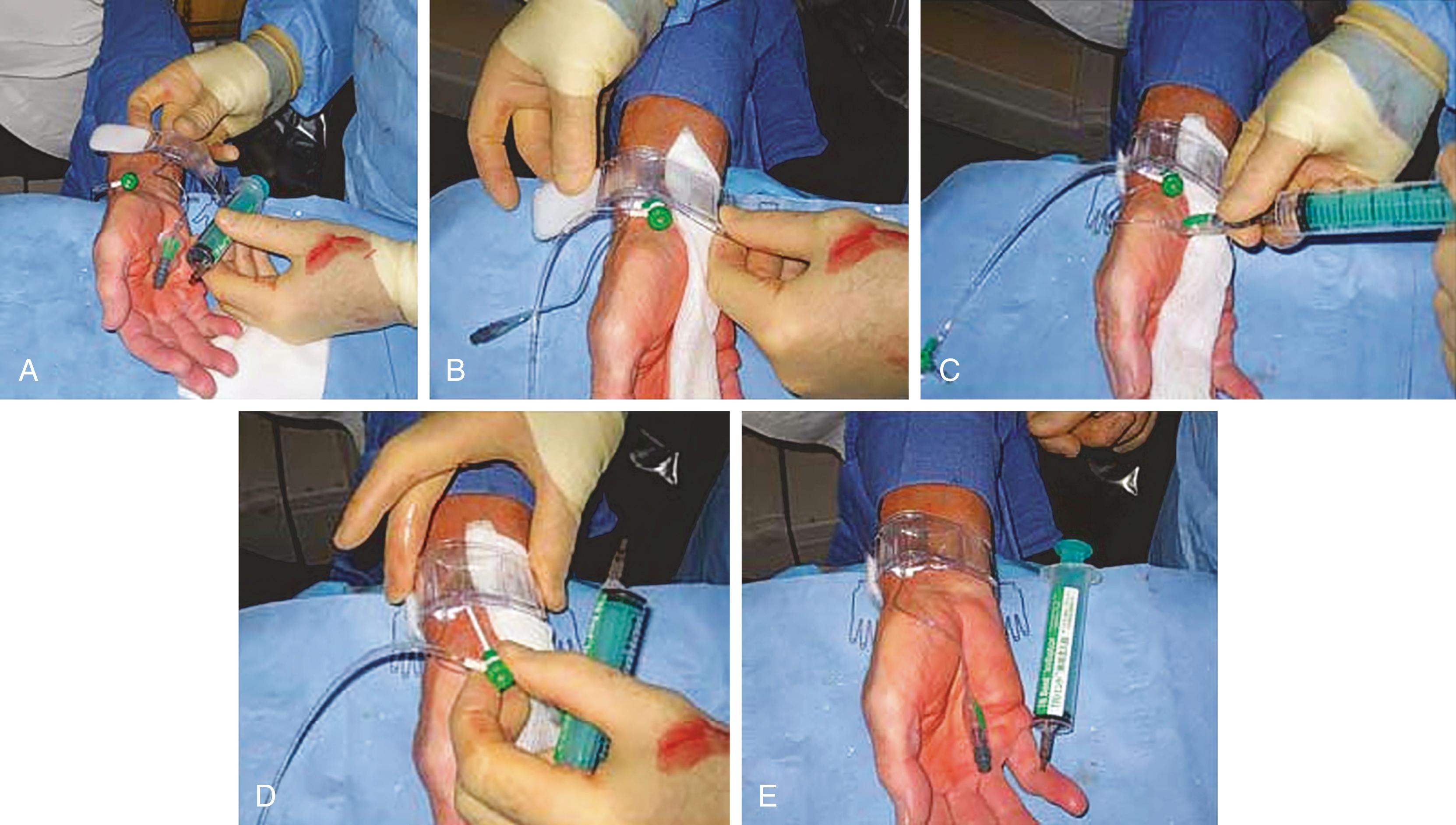 FIGURE 22.2, A, Radial sheath removal with Terumo band, which has an inflatable compression pad for hemostasis. B, Band is applied around the wrist with green dot over the arterial (not skin) puncture. A thin gauze wick is placed beneath the band to absorb blood when pressure is released to assess proper compression pressure in pad. C, Compression pad inflated. D, Sheath removed. E, Final result.