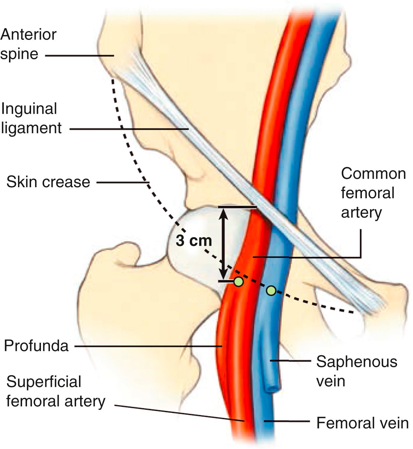 FIGURE 22.3, Regional anatomy relevant to percutaneous femoral arterial and venous catheterization.