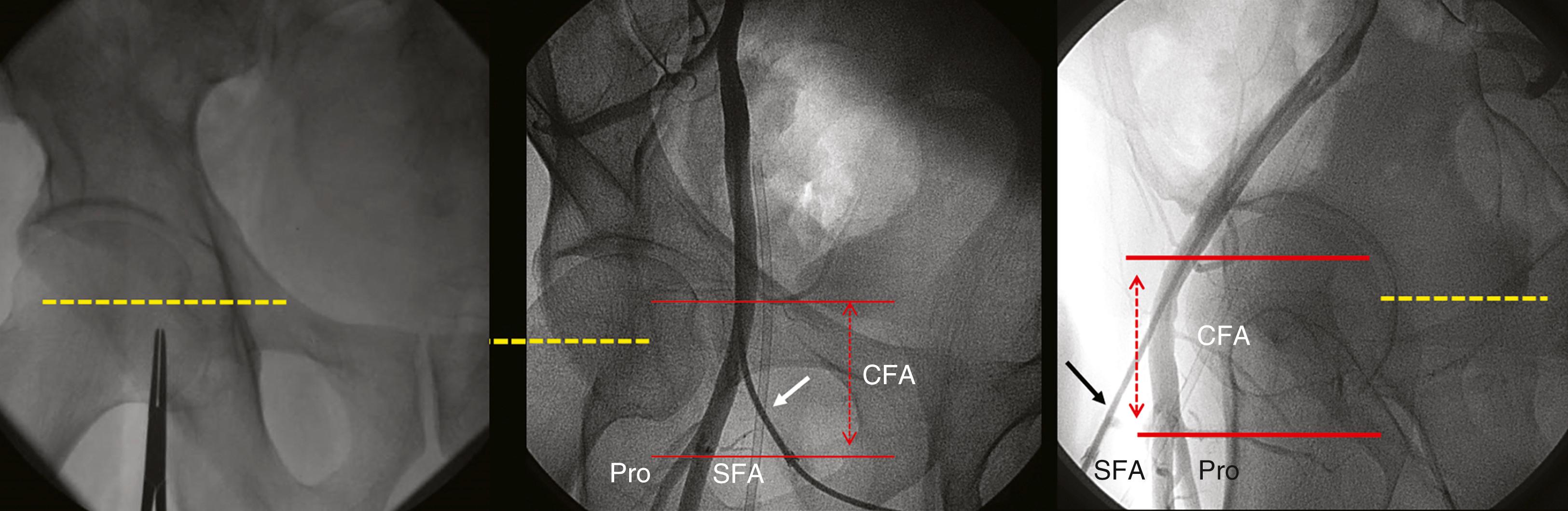 FIGURE 22.4, Left, Fluoroscopic localization of the skin nick (marked by the tip of the clamp). The middle of the femoral head is marked by the dashed yellow line. Middle, Angiogram of sheath in the femoral artery with a catheter ( arrow ) inserted in the common femoral artery. CFA is bounded by lower red line of the bifurcation of the superficial femoral artery (SFA) and profunda (Pro) branches and the upper red line of the inferior epigastric artery. Right , Lateral view of CFA (bounded by red lines) showing the relationship between the CFA and the bony femoral head, making manual compression effective.