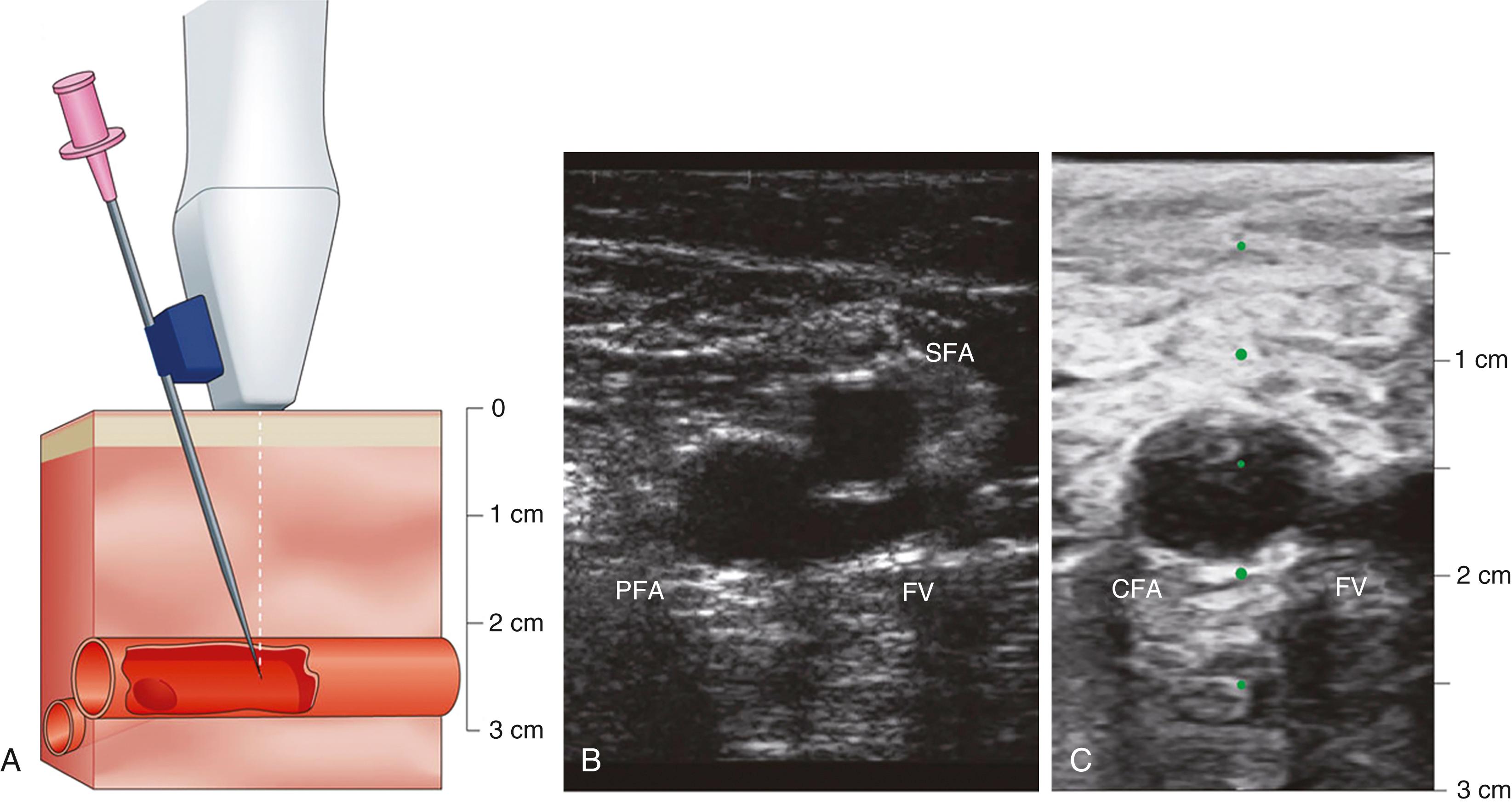 FIGURE 22.5, Ultrasound-guided femoral artery access.