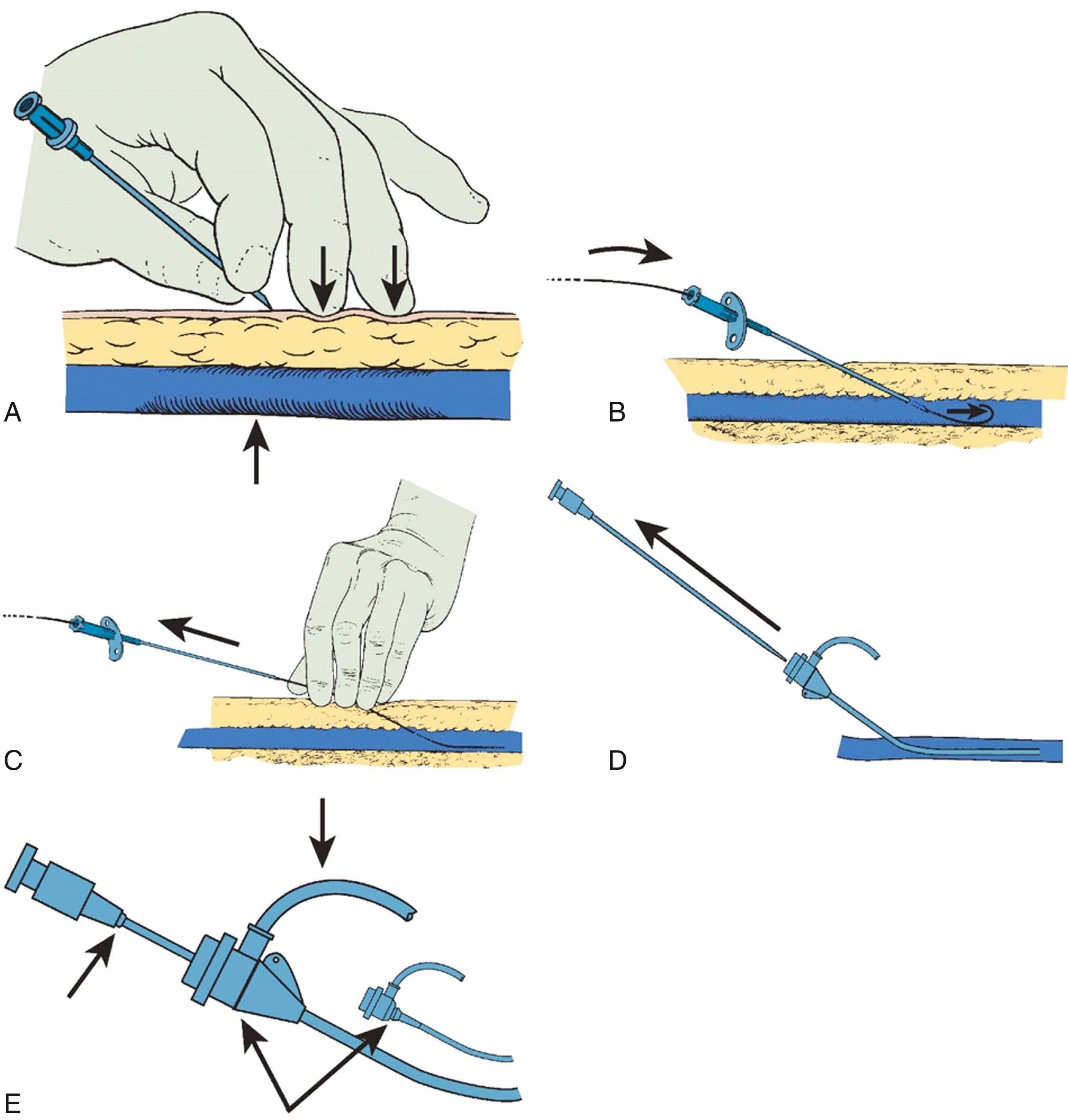 FIGURE 22.6, A, Femoral artery has been entered by a large-bore needle with backflow of blood. Note the operator’s finger positions. As soon as the needle passes into the vessel through the anterior wall, brisk pulsatile flow occurs. This technique is called the “front wall stick.” It prevents occult bleeding through the posterior wall. B, The flexible tip of the guidewire is passed through the needle into the vessel. C, Introducing a valve sheath into the artery. The needle is withdrawn, the artery is compressed, and the wire is pinched and fixed. D, The valve sheath is advanced over a guidewire, and the dilator and guidewire are removed. E, Arrows indicate position of sewing rings to attach valve to skin should prolonged insertion be required.