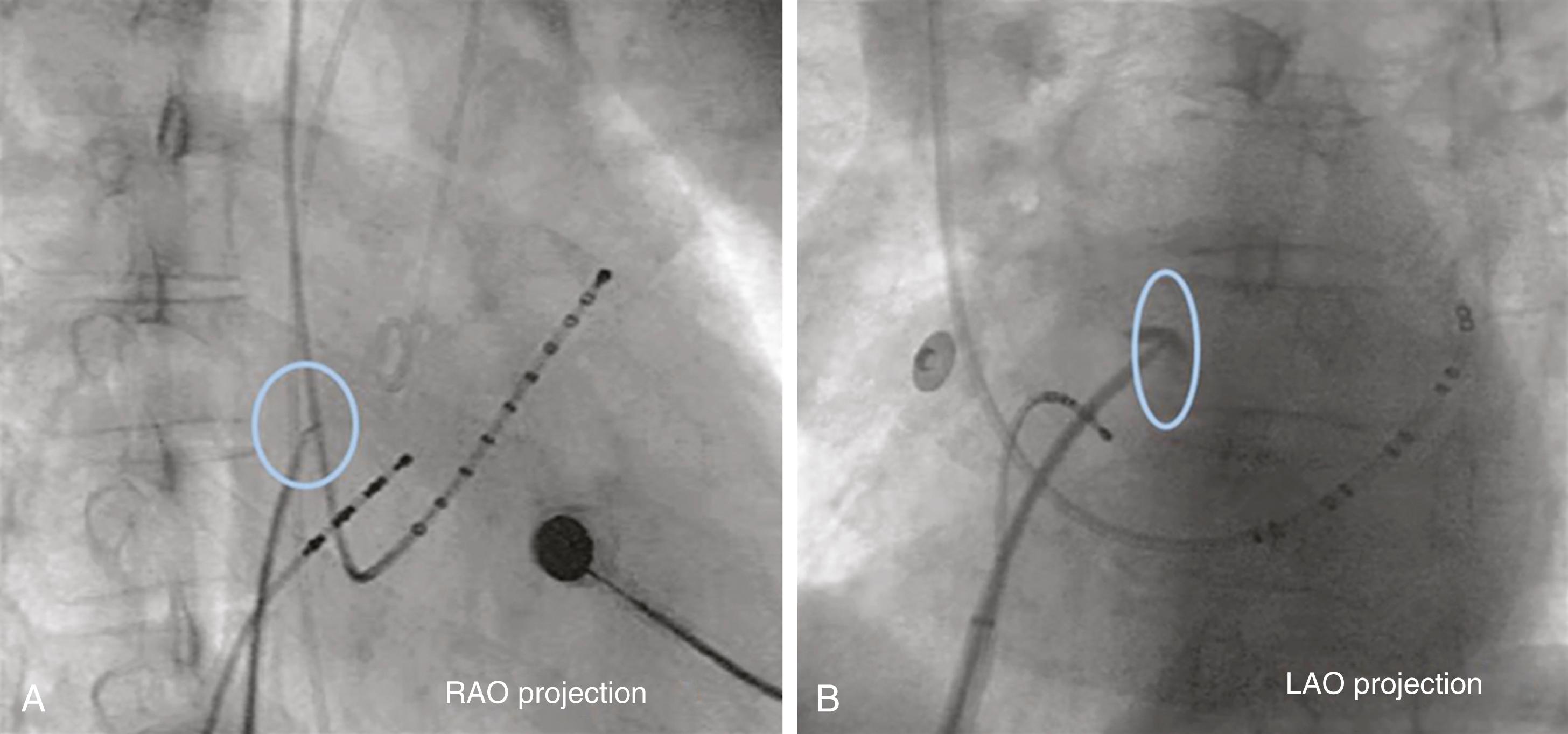 FIGURE 22.7, Septum crossing in fluoroscopy-guided transseptal puncture engaging the fossa ovalis in the right anterior oblique (RAO) (A) and left anterior oblique (LAO) (B) projections. Blue circle/oval indicate the fossa ovalis. Note the staining of the fossa ovalis in the LAO view. A pigtail is present in the RAO projection to mark the anterior location of the aorta.