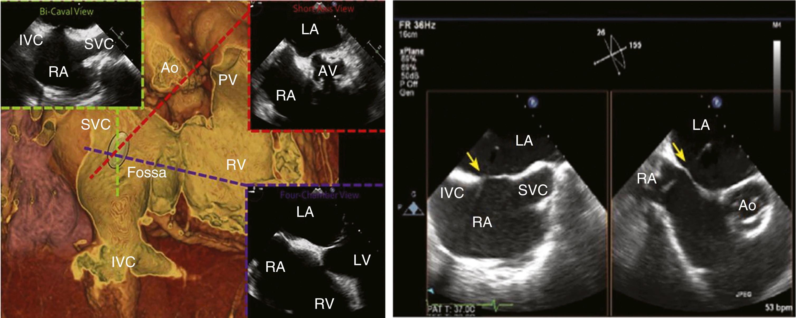 FIGURE 22.8, Biplane transesophageal echocardiography for transseptal puncture. AV, Aortic valve; PV, pulmonary vein; SVC, superior vena cava; other abbreviations as in Figure 22.2.