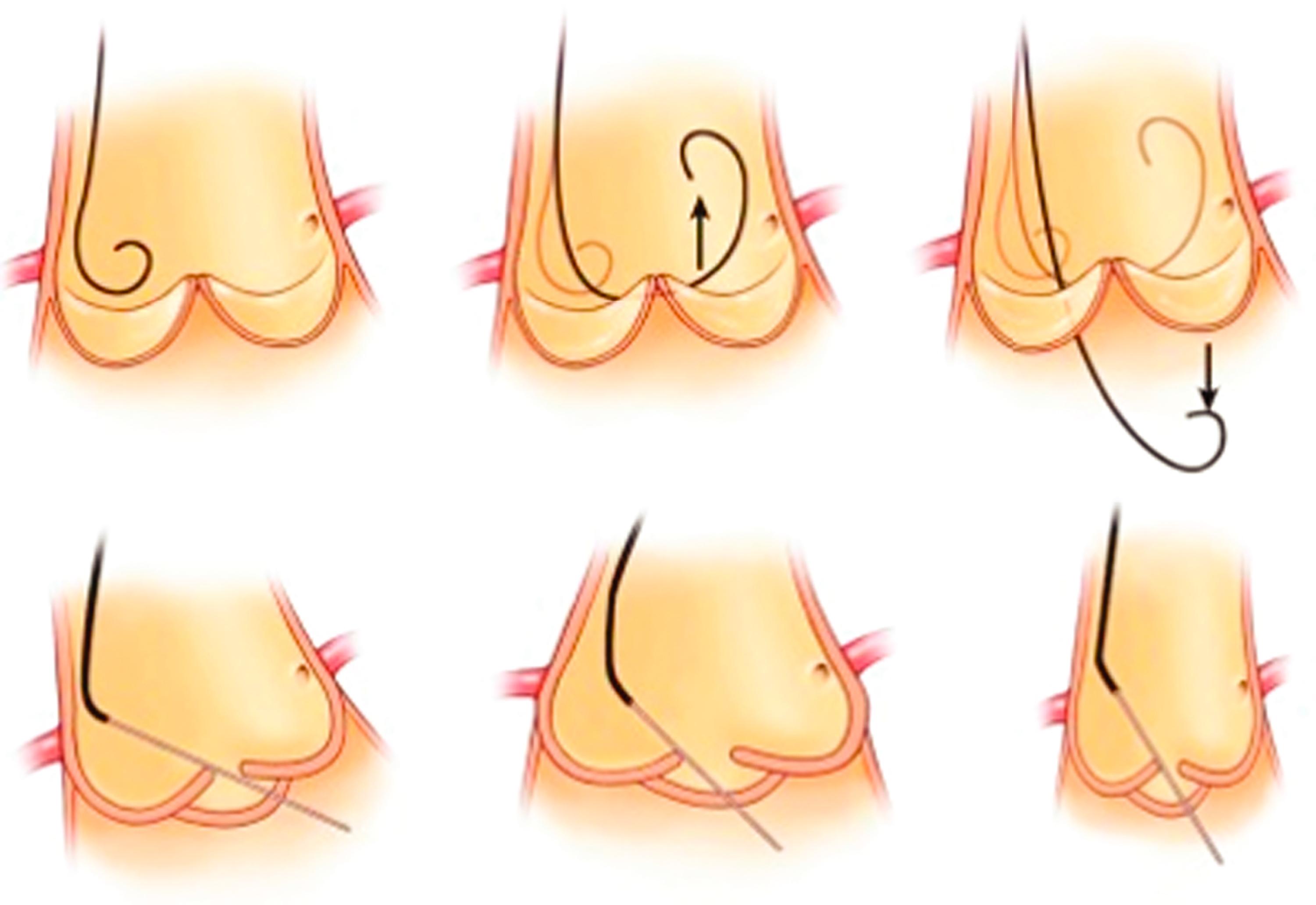 FIGURE 22.9, Technique for retrograde crossing of an aortic valve by a pigtail catheter.