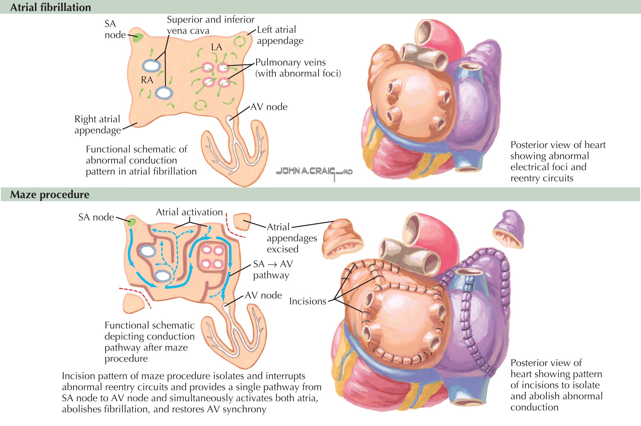 FIG 40.1, Surgical Management of Atrial Fibrillation .