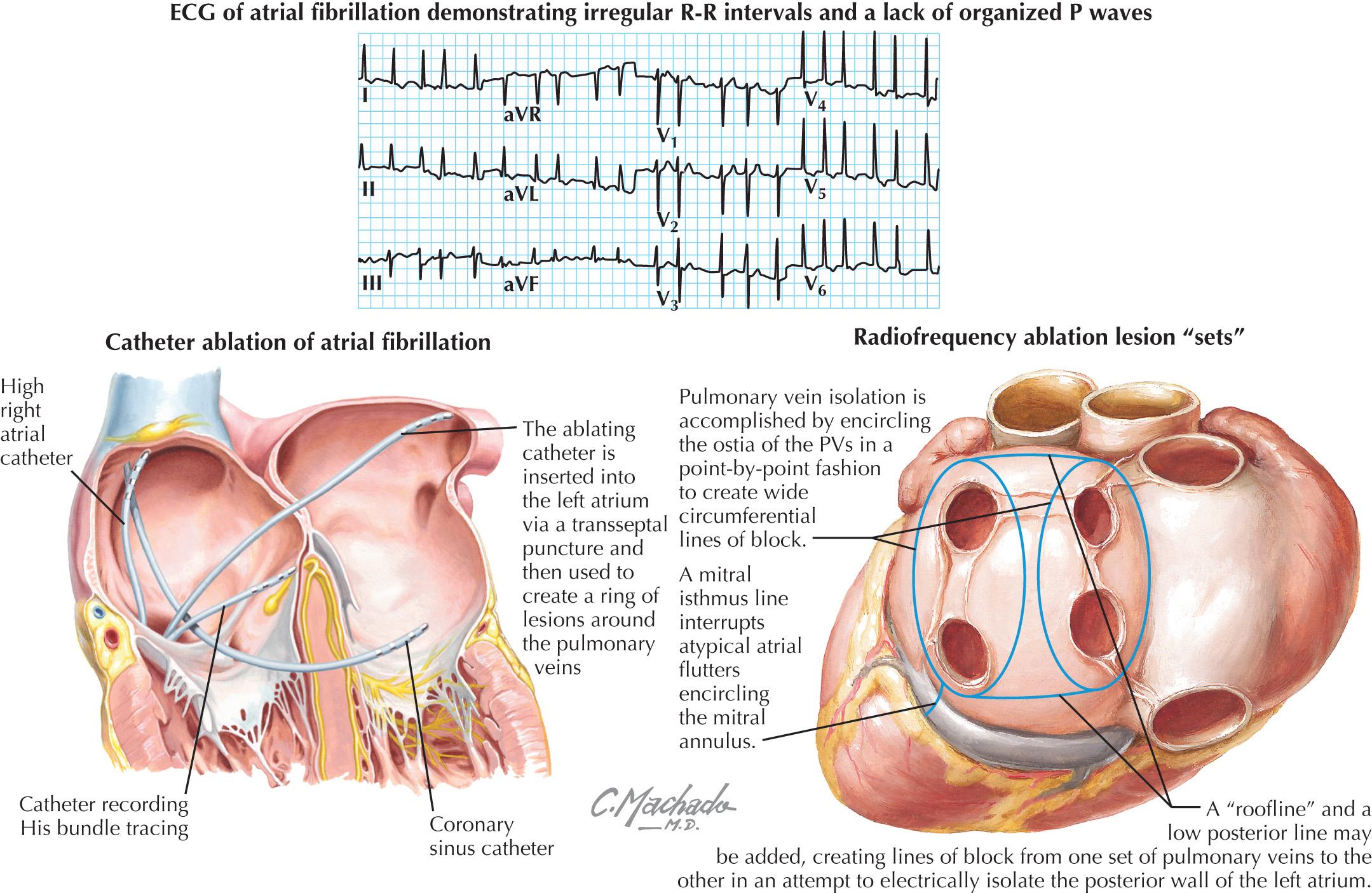 FIG 40.2, Catheter Ablation of Atrial Fibrillation.