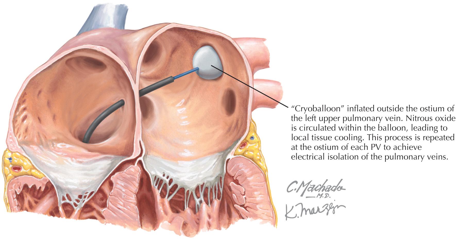 FIG 40.3, Cryoballoon Ablation of Atrial Fibrillation.