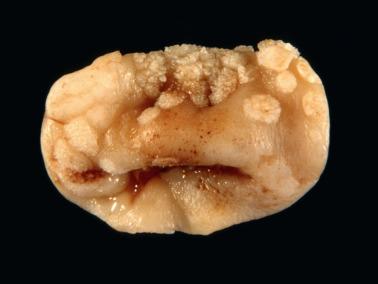 Fig. 5.1, Condyloma acuminatum. Multiple irregular papillary and flat white lesions involved the ectocervix.