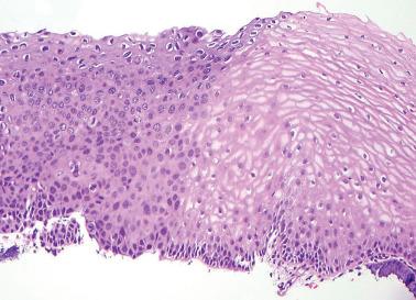 Fig. 5.11, HSIL (CIN 3) with adjacent normal squamous epithelium.