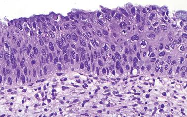 Fig. 5.13, HSIL (CIN 3).