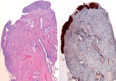 Fig. 5.14, HSIL confined to the surface of an endocervical polyp (left, H&E; right, p16 stain).