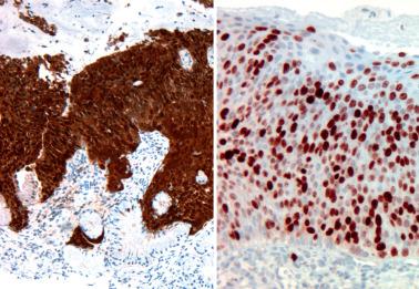 Fig. 5.15, HSIL showing diffuse full-thickness staining for p16 (left) and MIB1 (right).