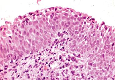 Fig. 5.18, Typical immature squamous metaplasia.